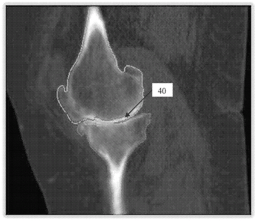 Multi-bone segmentation for 3D computed tomography