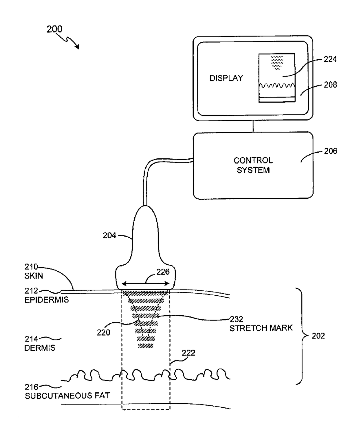 Method and system for ultrasound treatment of skin