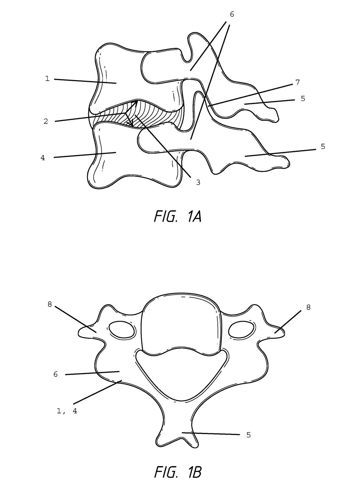 Intervertebral disc implant and method for restoring function to a damaged functional spinal unit