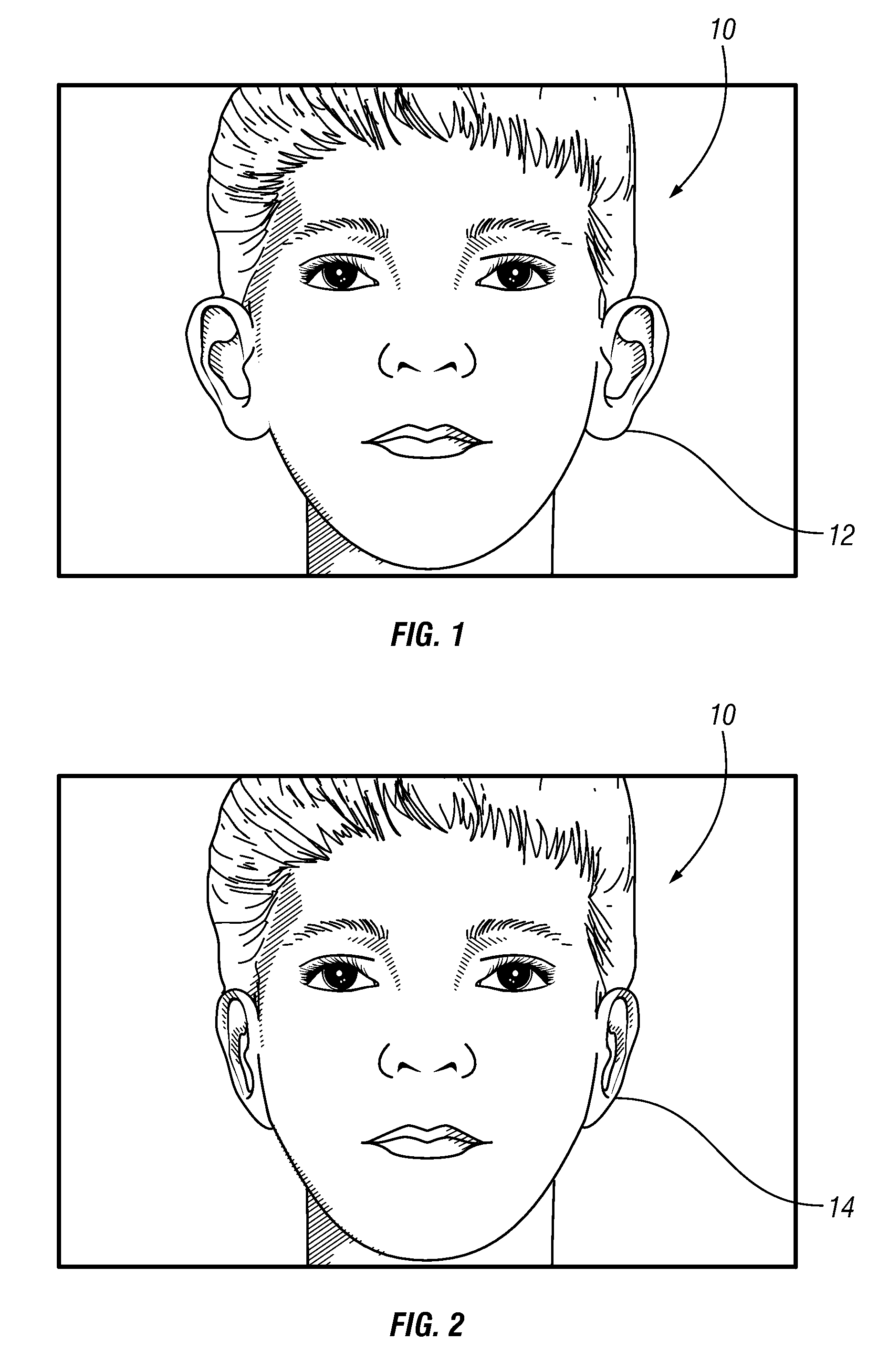 Method and means for pinning back protruding ears