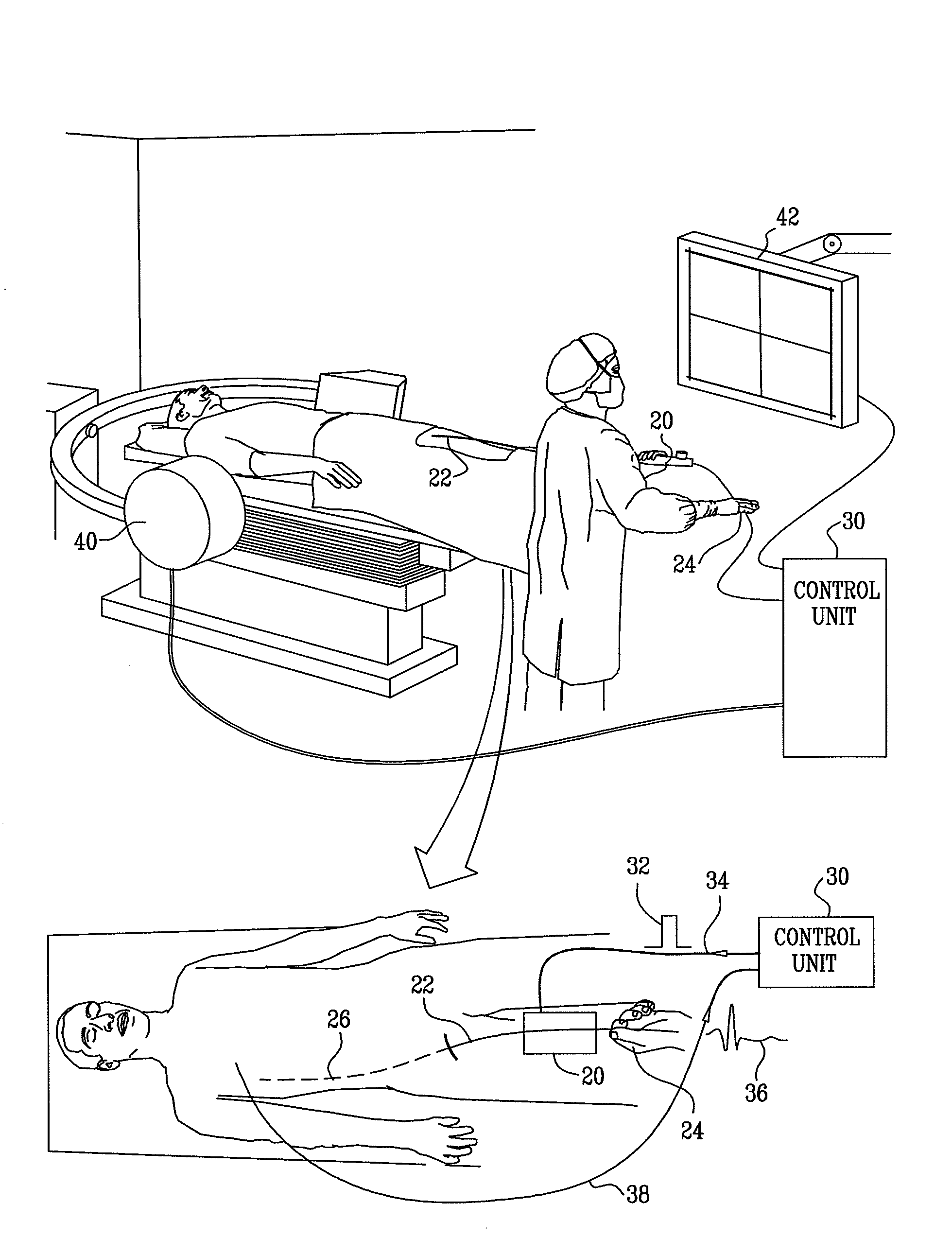 Stepwise advancement of a medical tool
