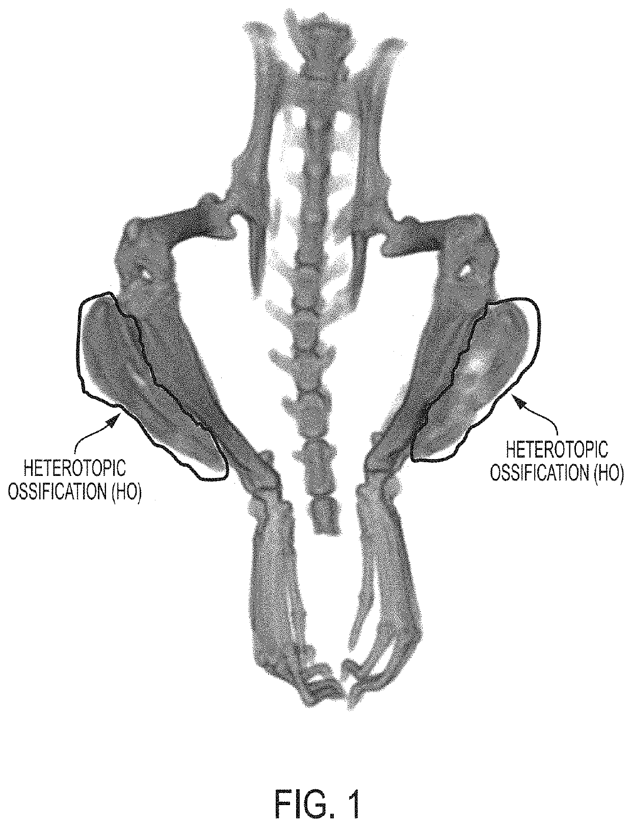 Systems and methods for automated analysis of heterotopic ossification in 3D images