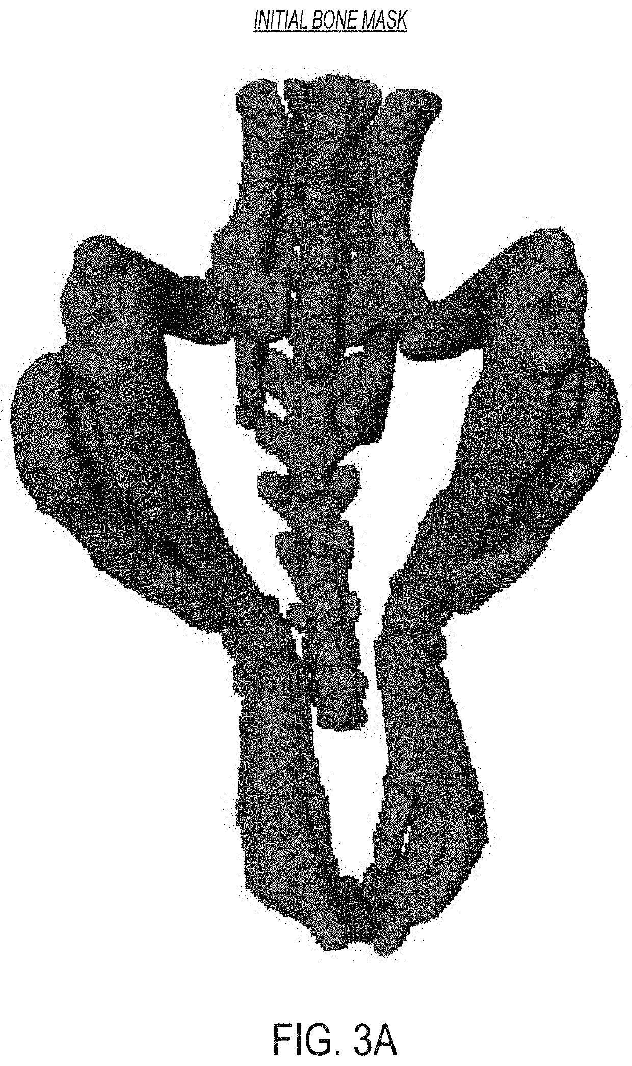 Systems and methods for automated analysis of heterotopic ossification in 3D images