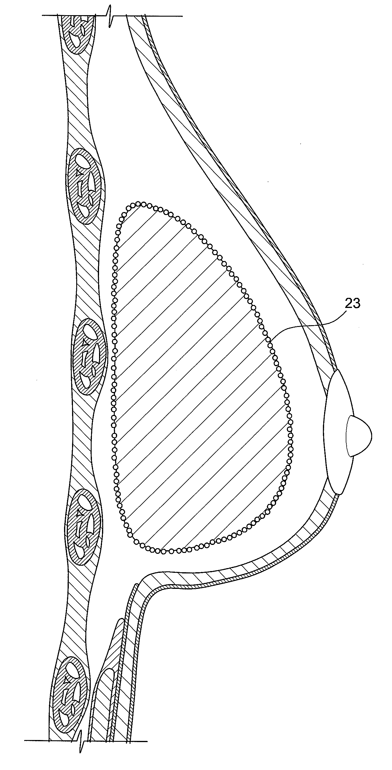 Method for texturing the surface of a synthetic implant