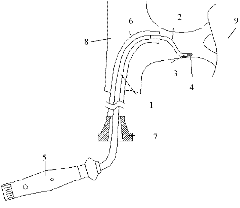 Renal artery radiofrequency ablation catheter