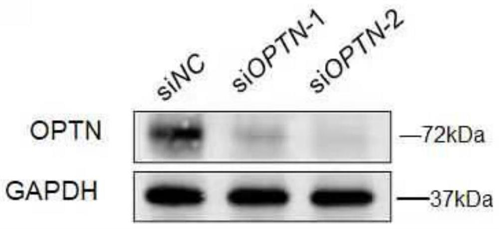 Application of Optineurin (OPTN) in diagnosis and treatment of ocular melanoma