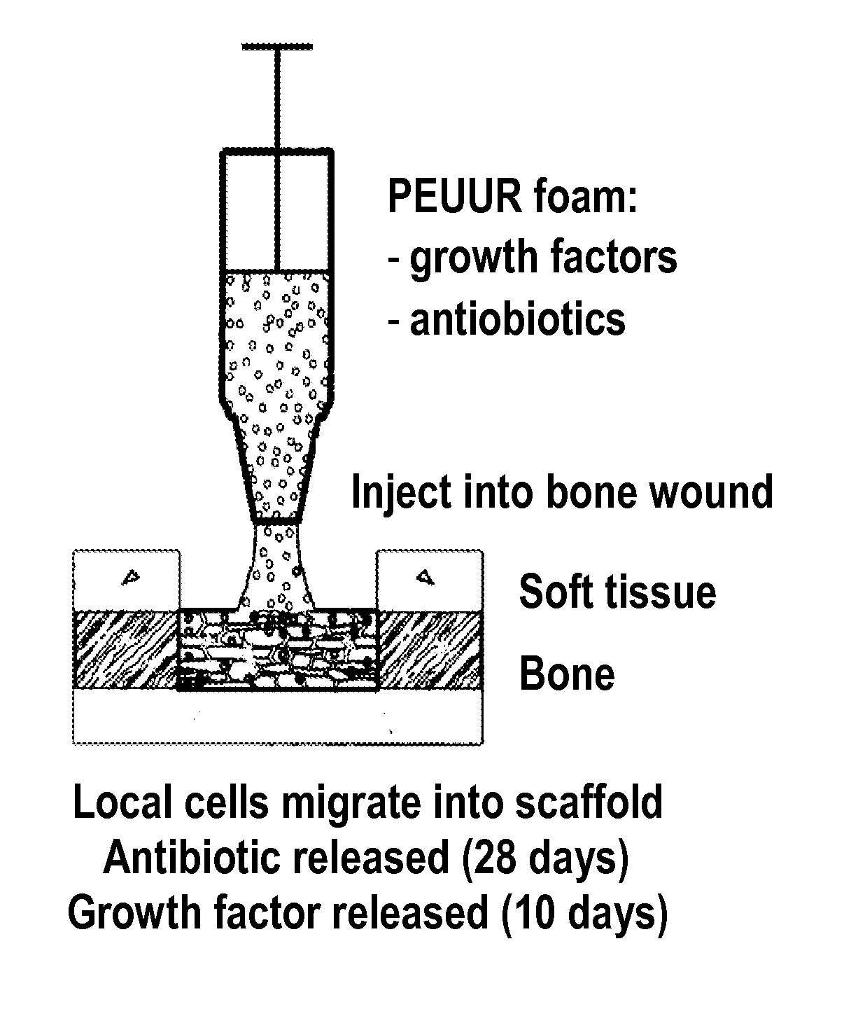 Release of antibiotic from injectable, biodegradable polyurethane scaffolds for enhanced bone fracture healing