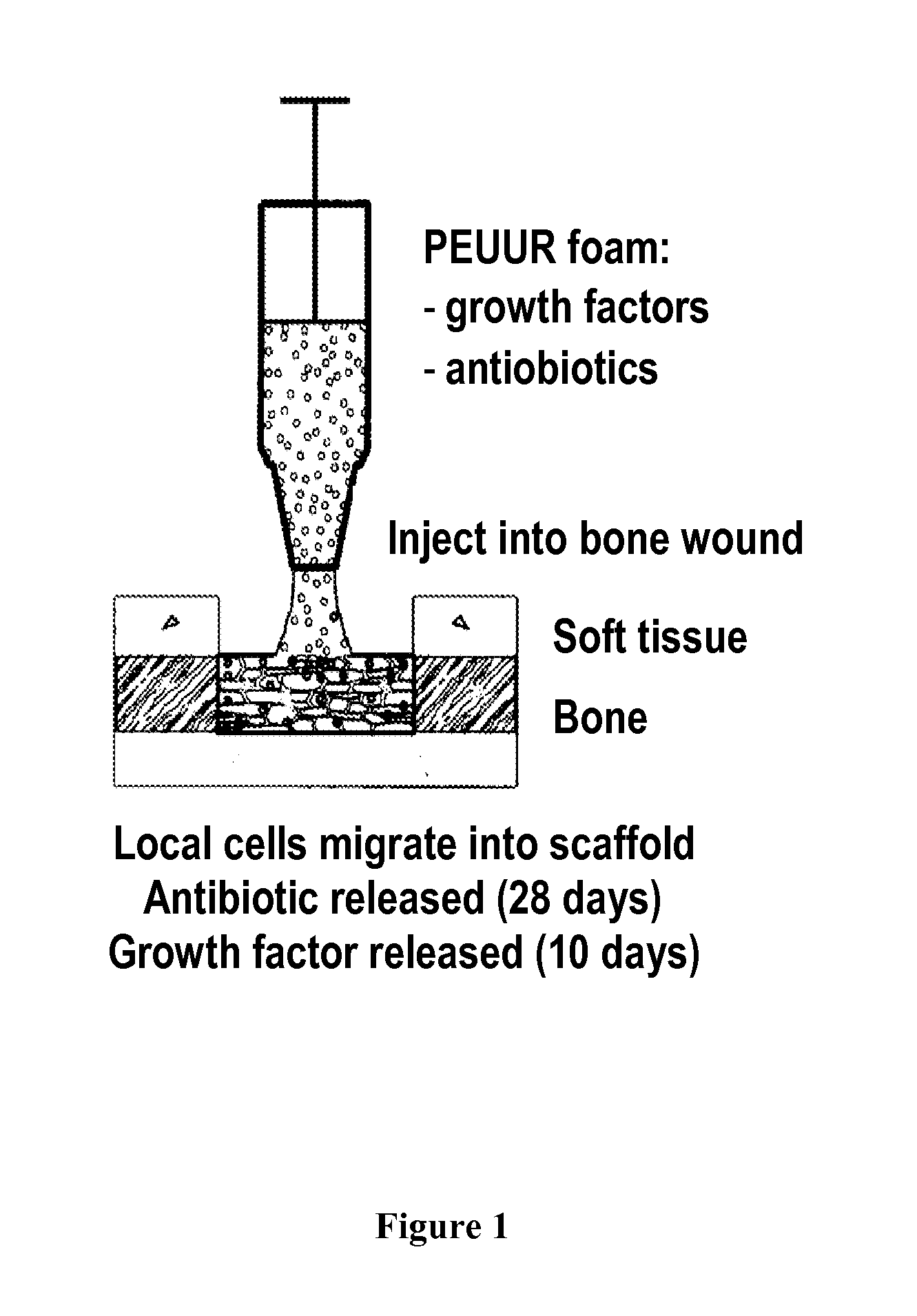 Release of antibiotic from injectable, biodegradable polyurethane scaffolds for enhanced bone fracture healing