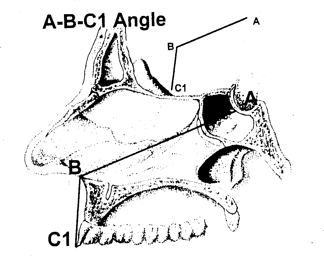 Operation positioning method from sphernoidal sinus to saddle ragion and simple positioning instrument