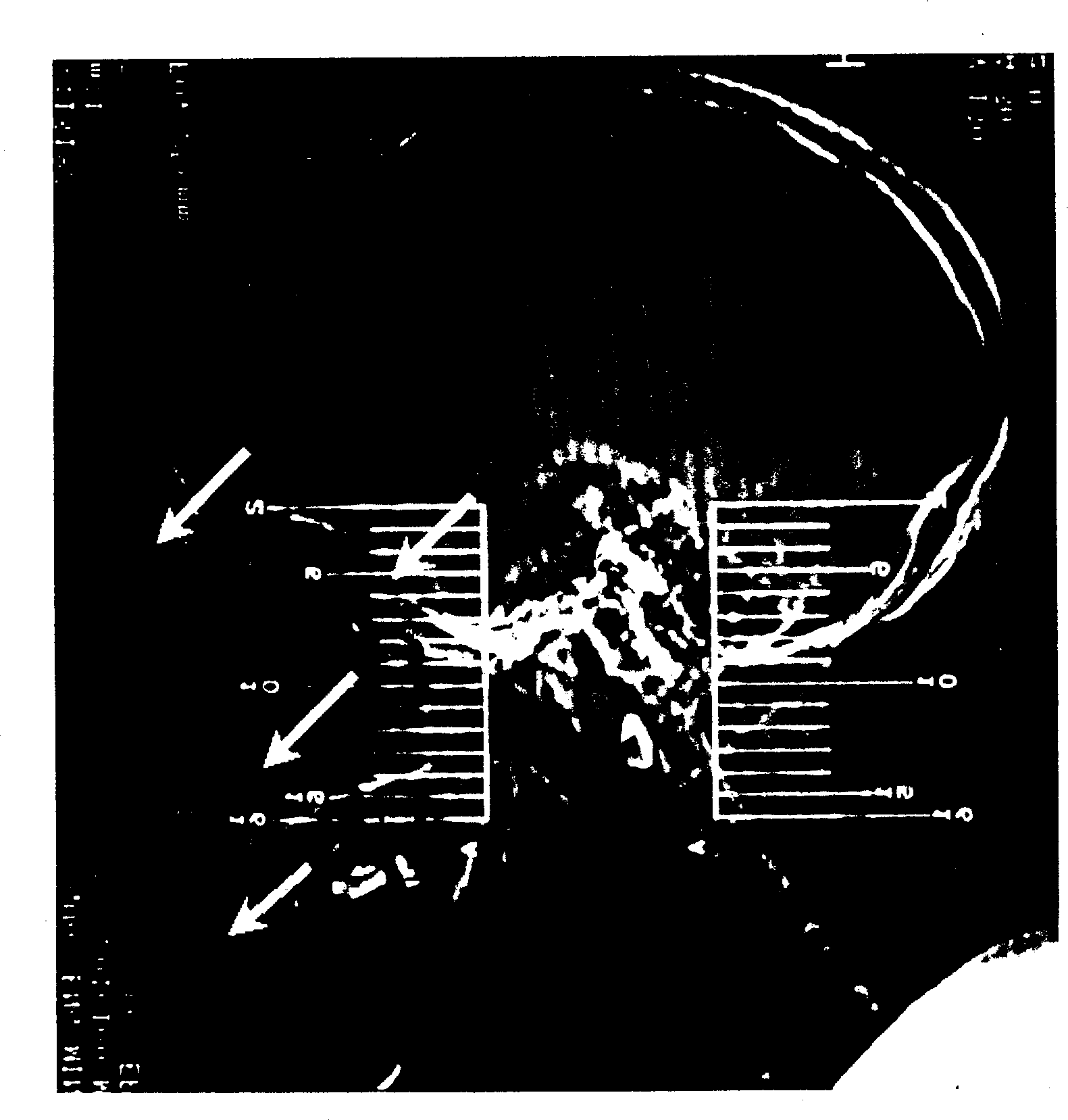 Operation positioning method from sphernoidal sinus to saddle ragion and simple positioning instrument