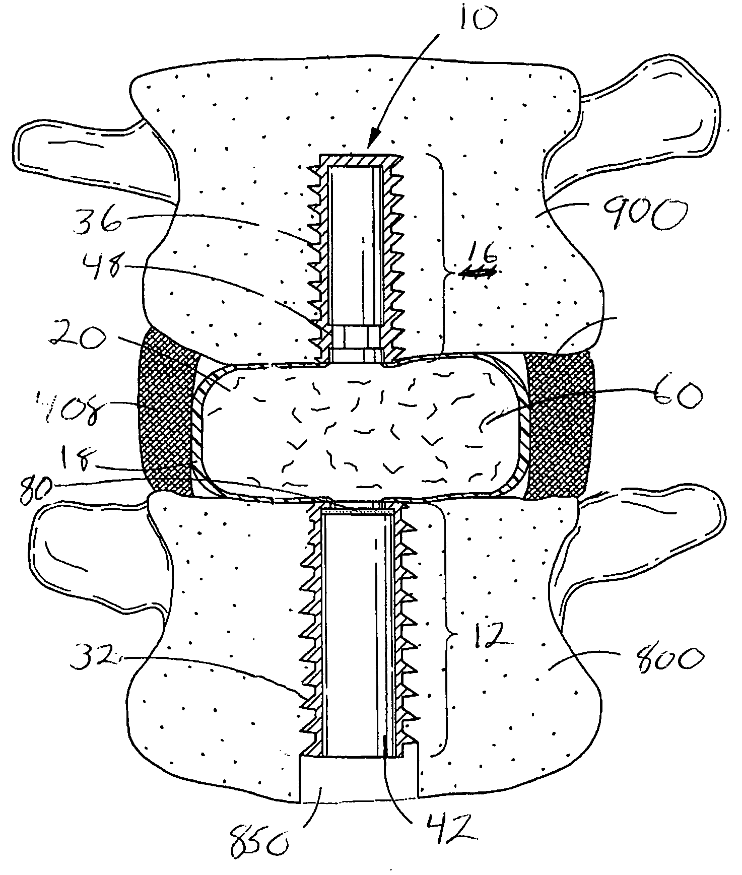 Dual anchor prosthetic nucleus apparatus