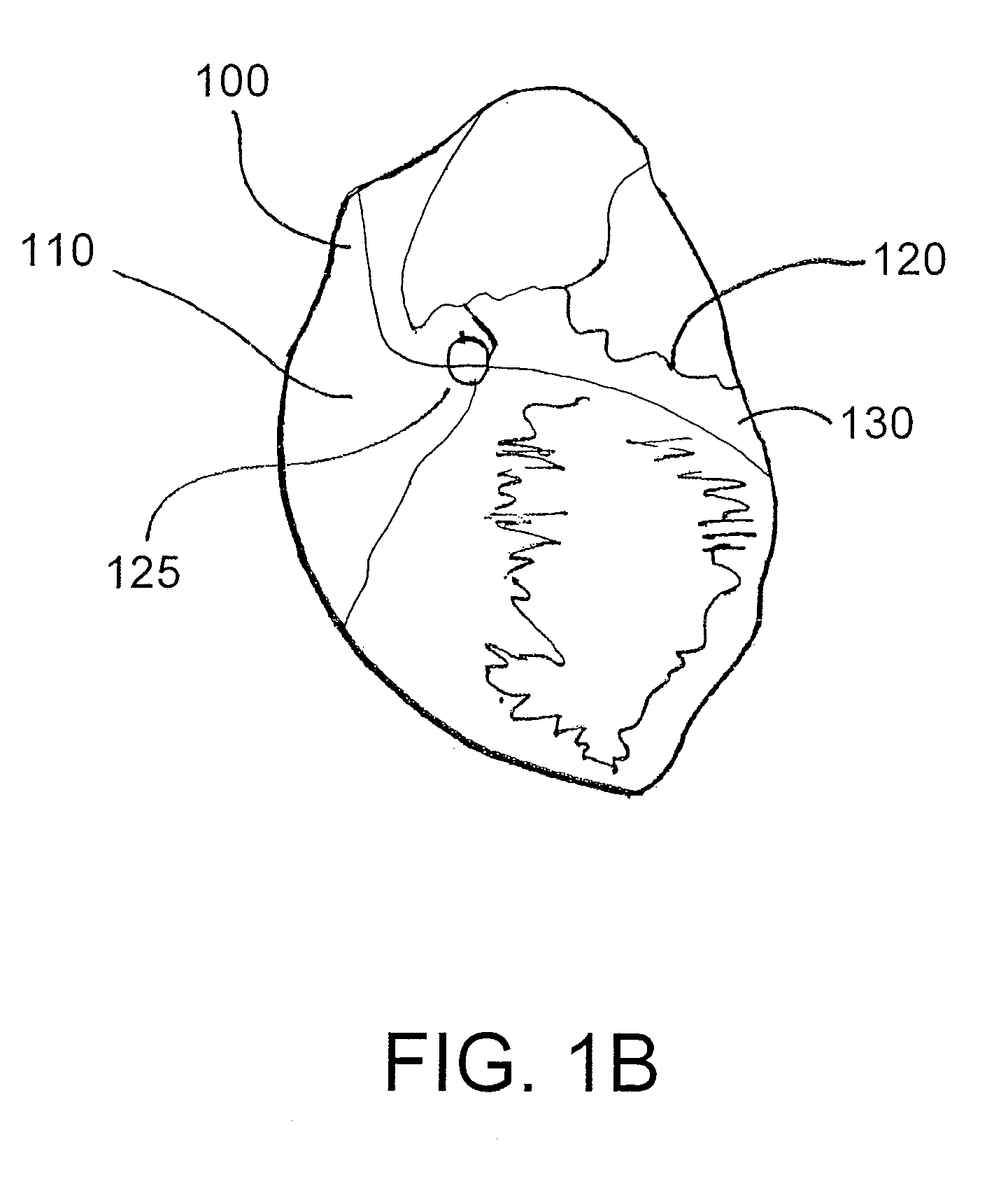 Devices, systems, and methods for myocardial infarct border zone reinforcement
