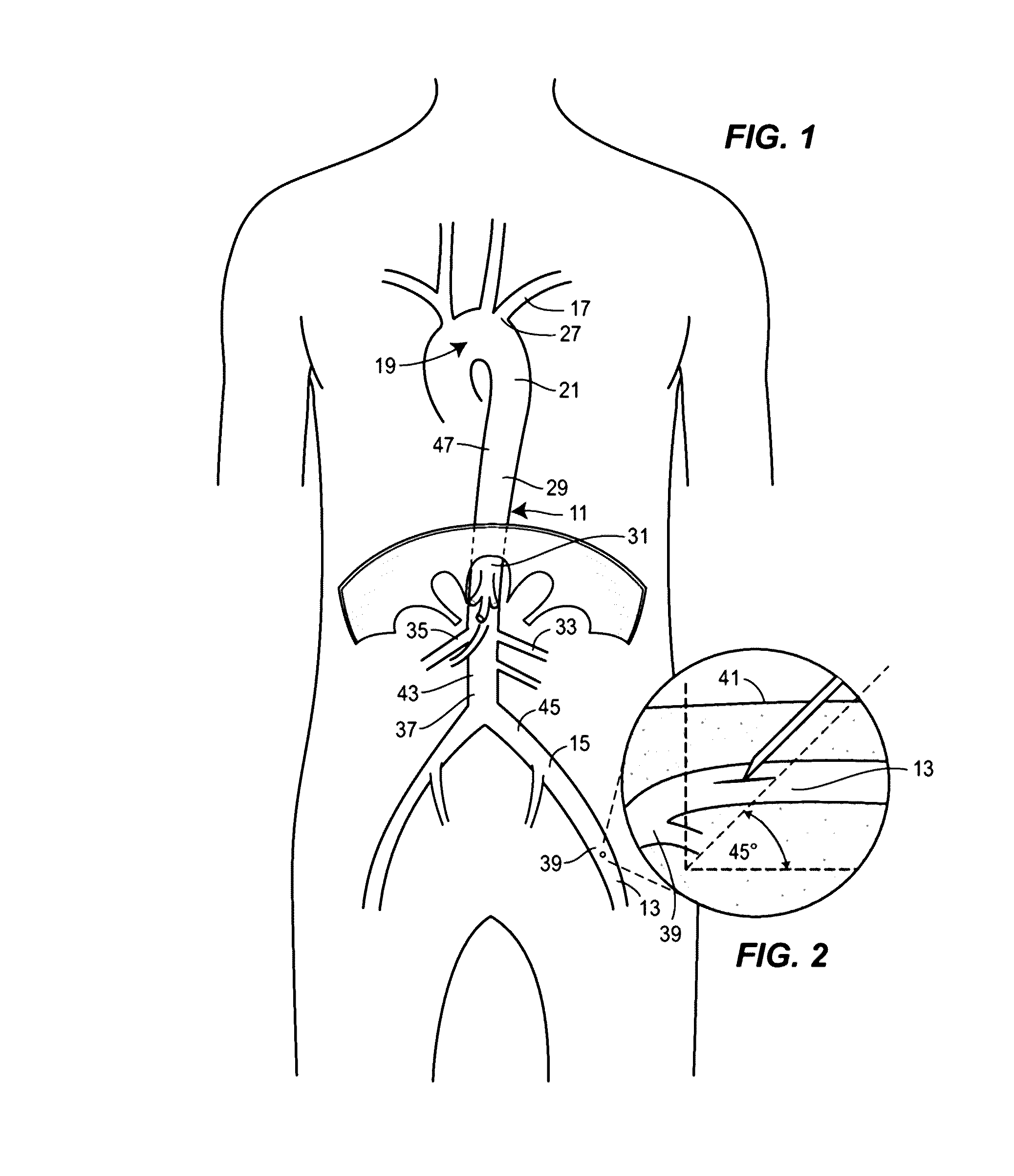 Fluoroscopy-independent balloon guided occlusion catheter and methods