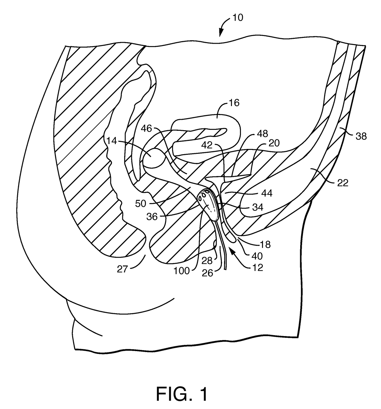 Vaginal insert device having a support portion with plurality of foldable areas