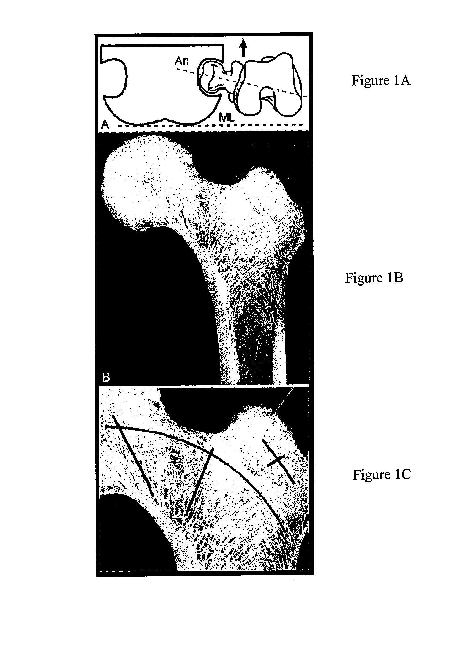 Templates for assessing bone quality and methods of use thereof