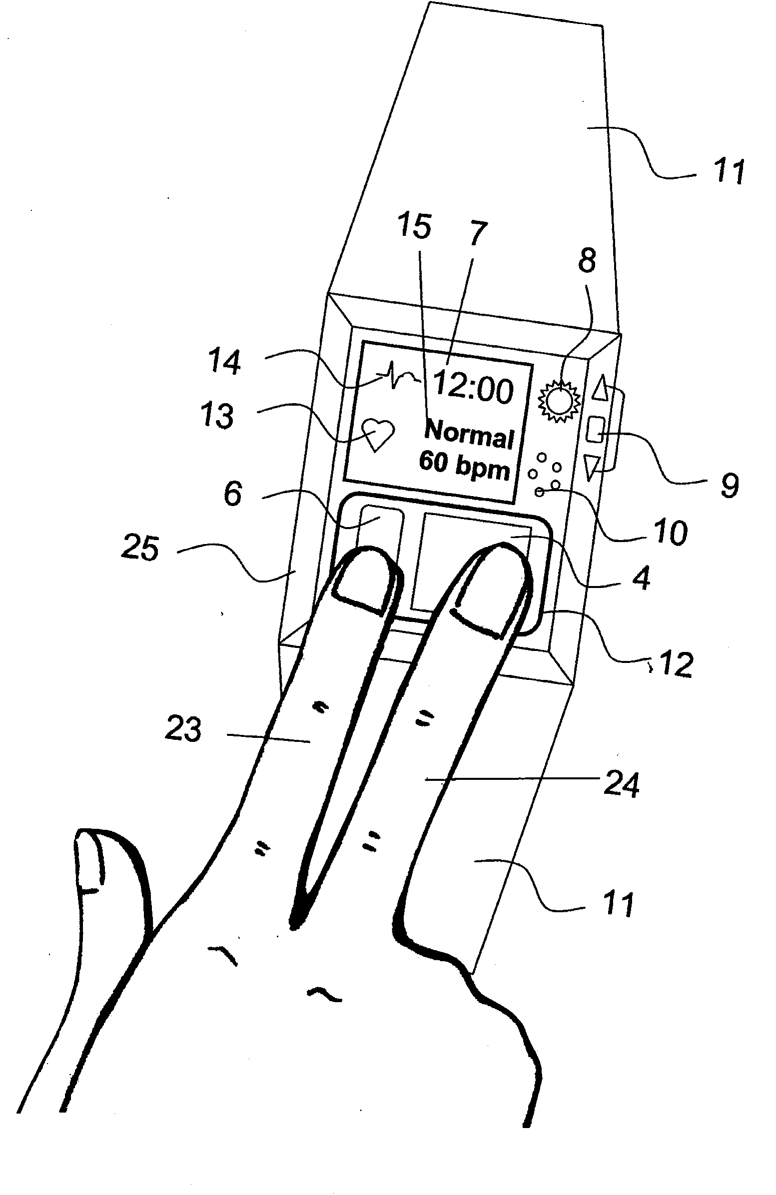 Device and Method for Measuring Three-Lead ECG in a Wristwatch