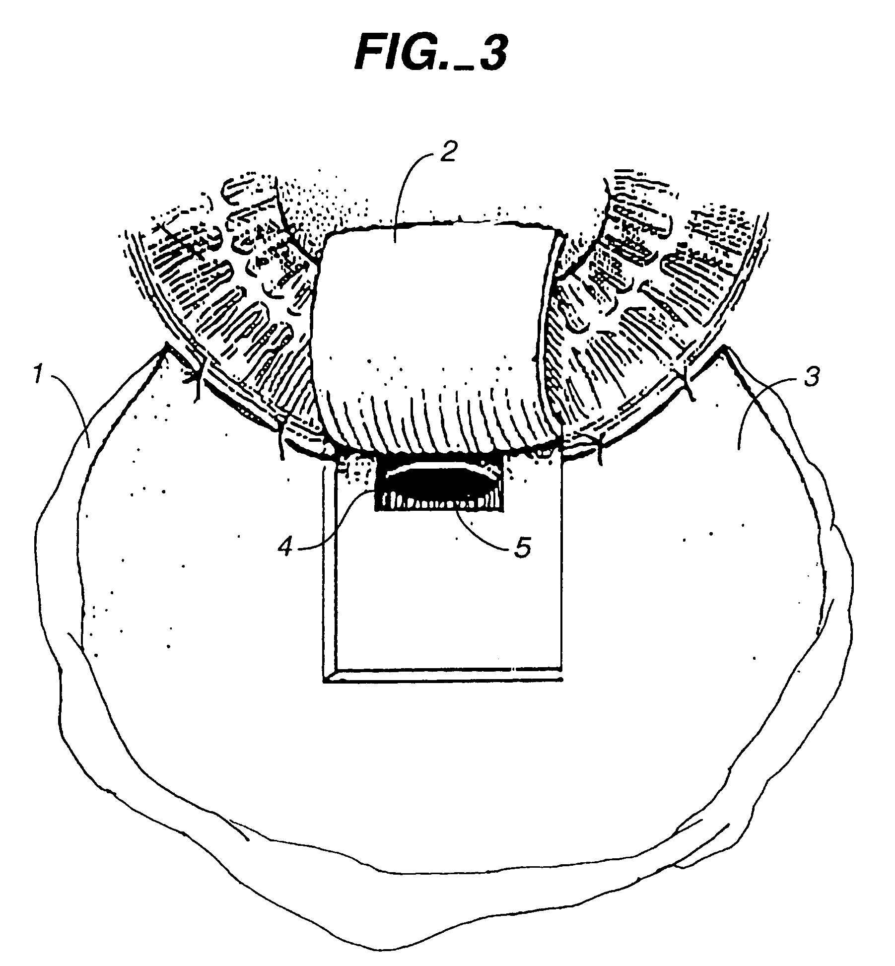 Compositions and methods for treating glaucoma