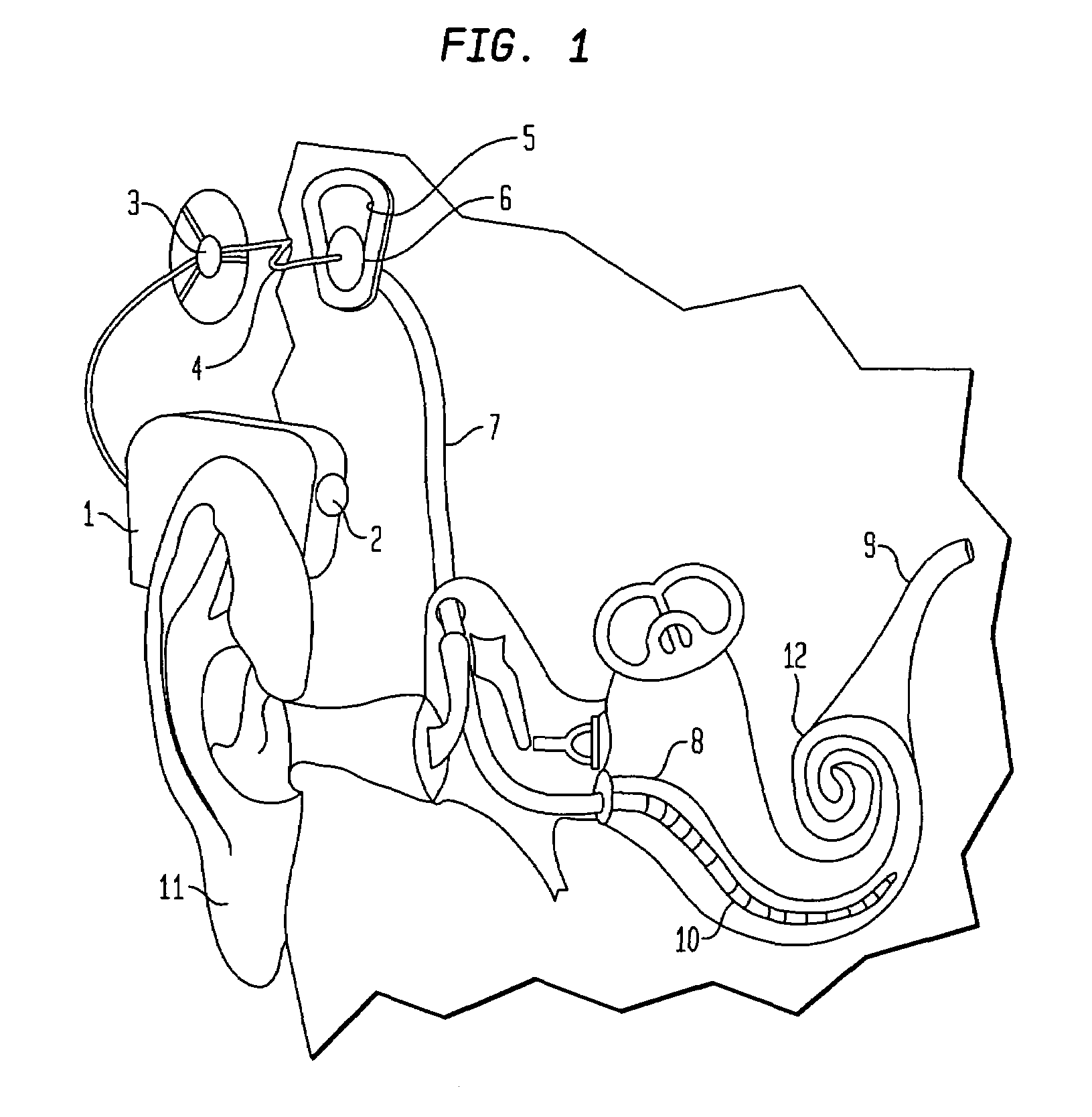 Cochlear implant having patient-specific parameter storage