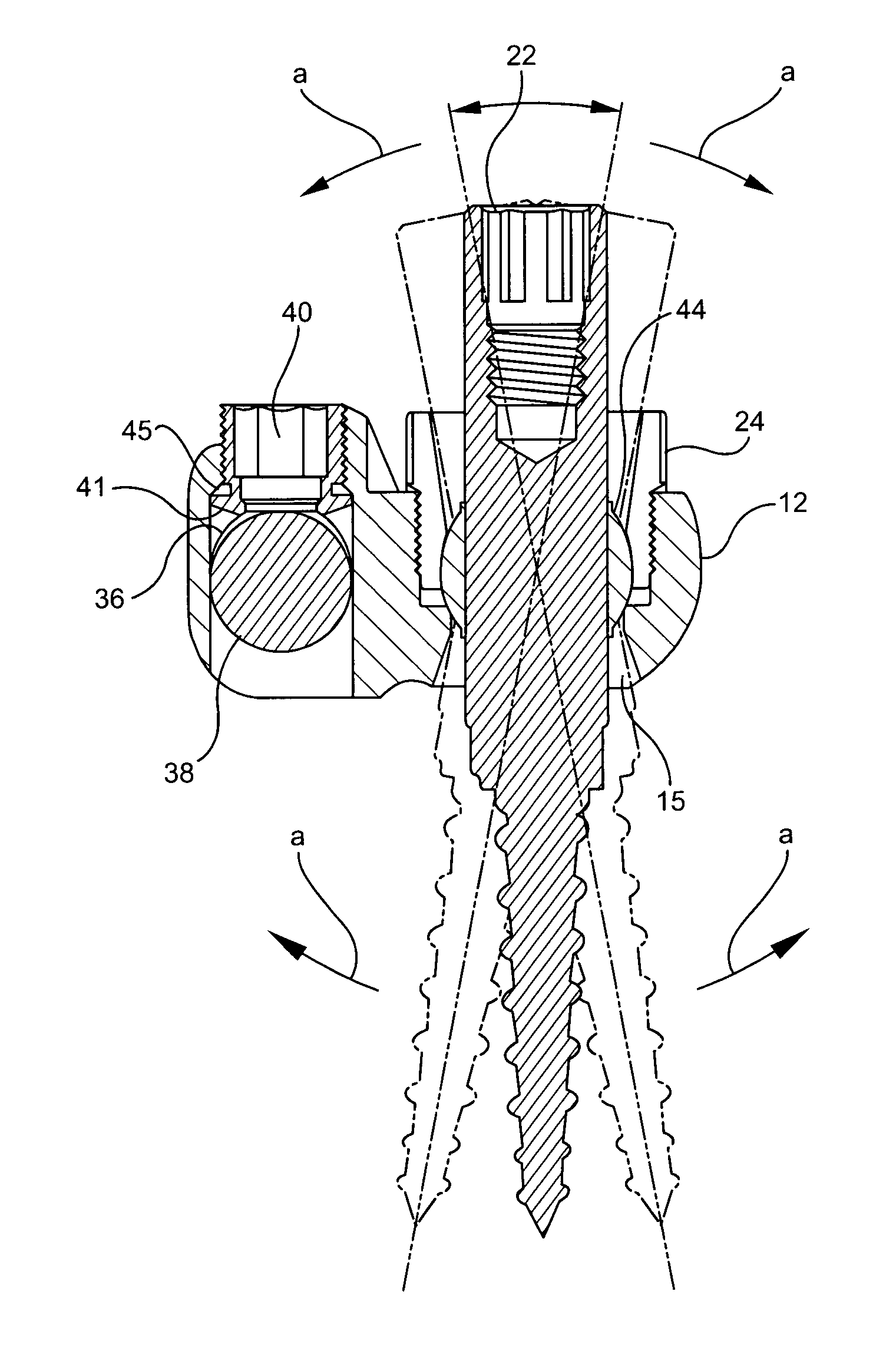 Bone fixation assembly and method