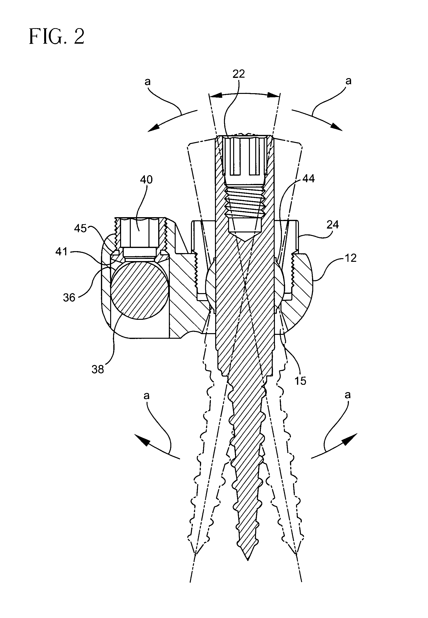 Bone fixation assembly and method