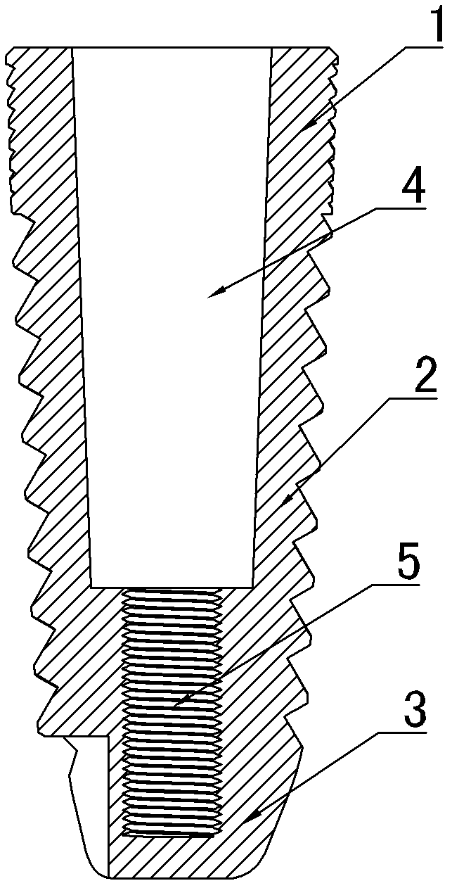 Oral cavity implant and module thereof