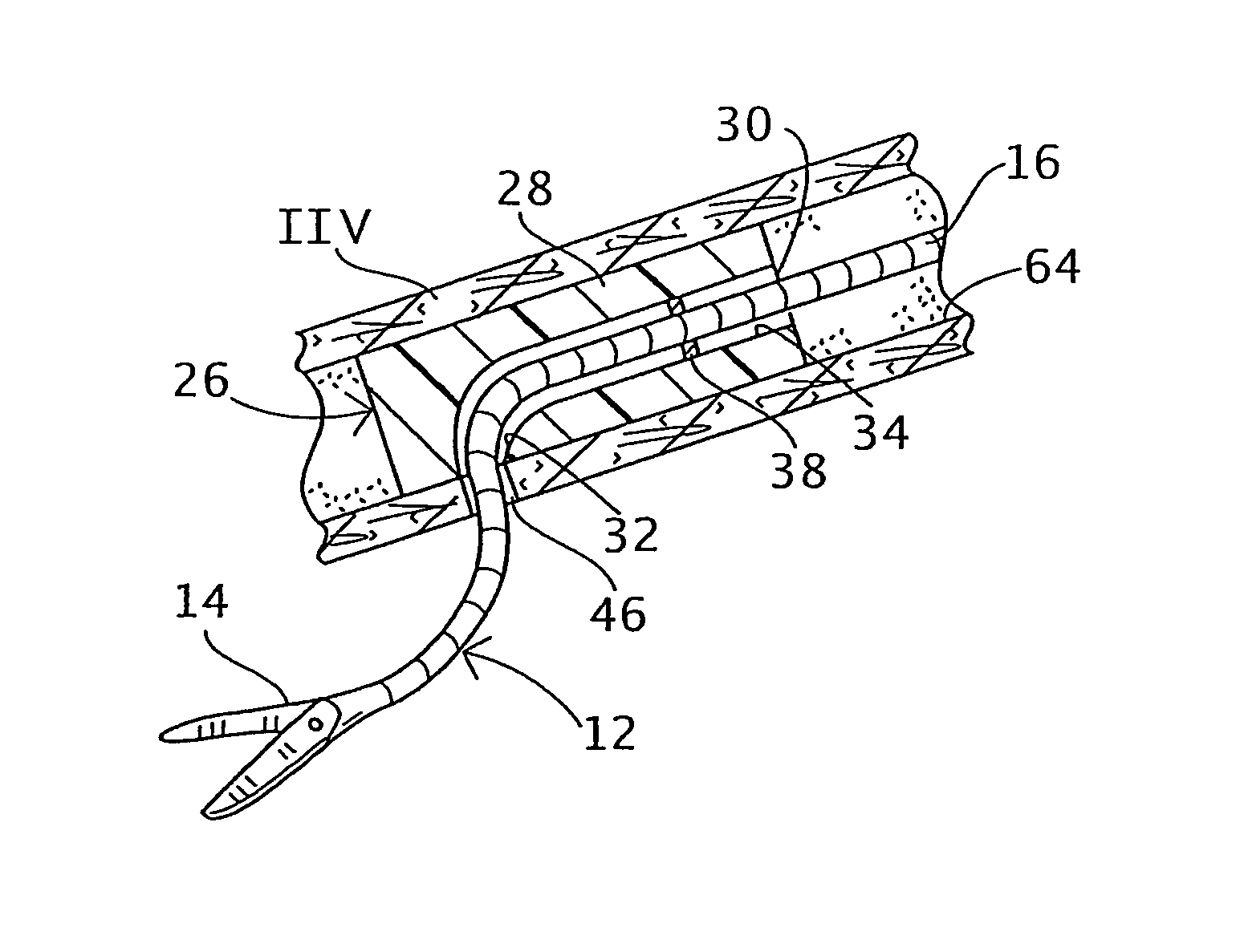 Trans-vascular surgical method and associated device