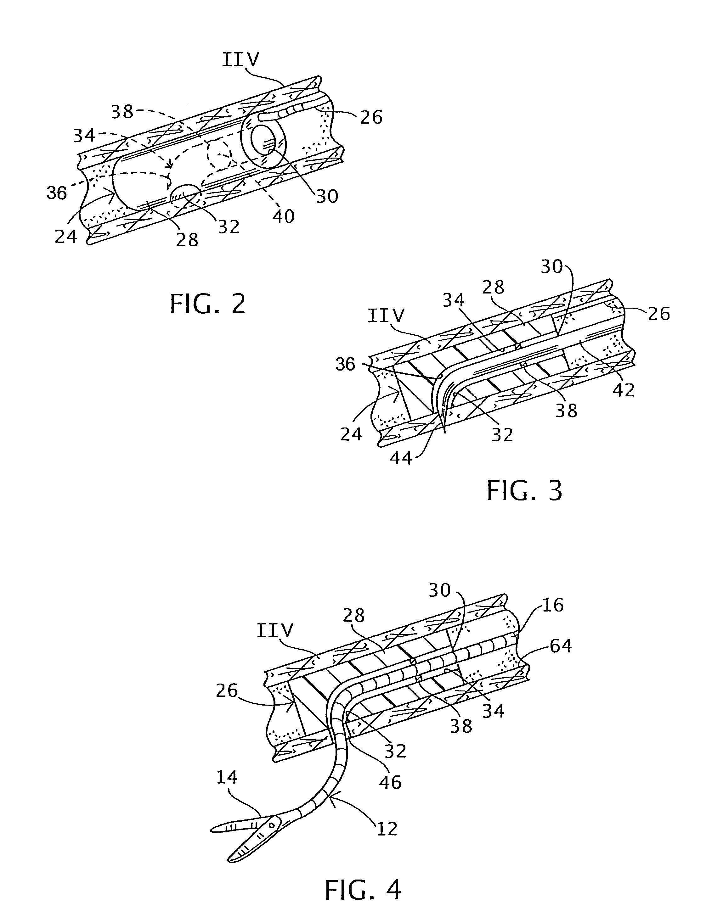 Trans-vascular surgical method and associated device