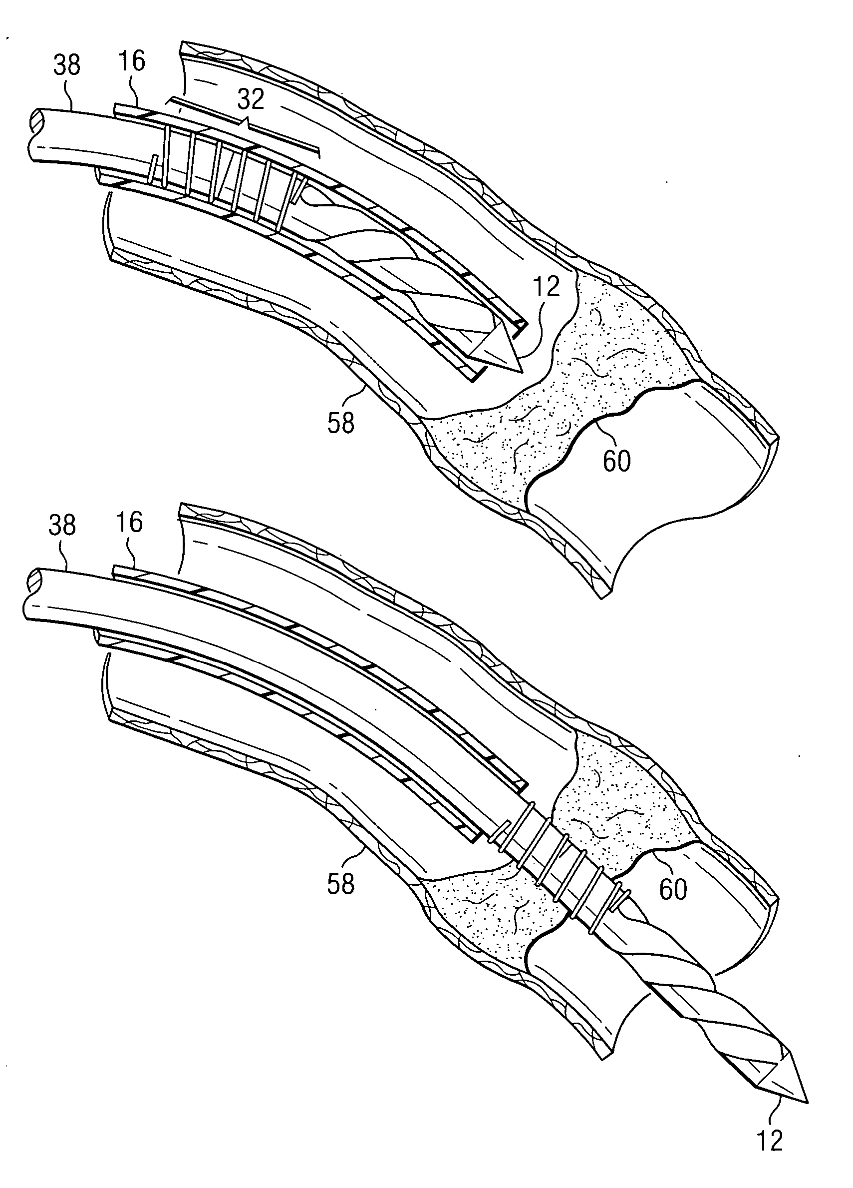 System and method for addressing total occlusion in a vascular environment