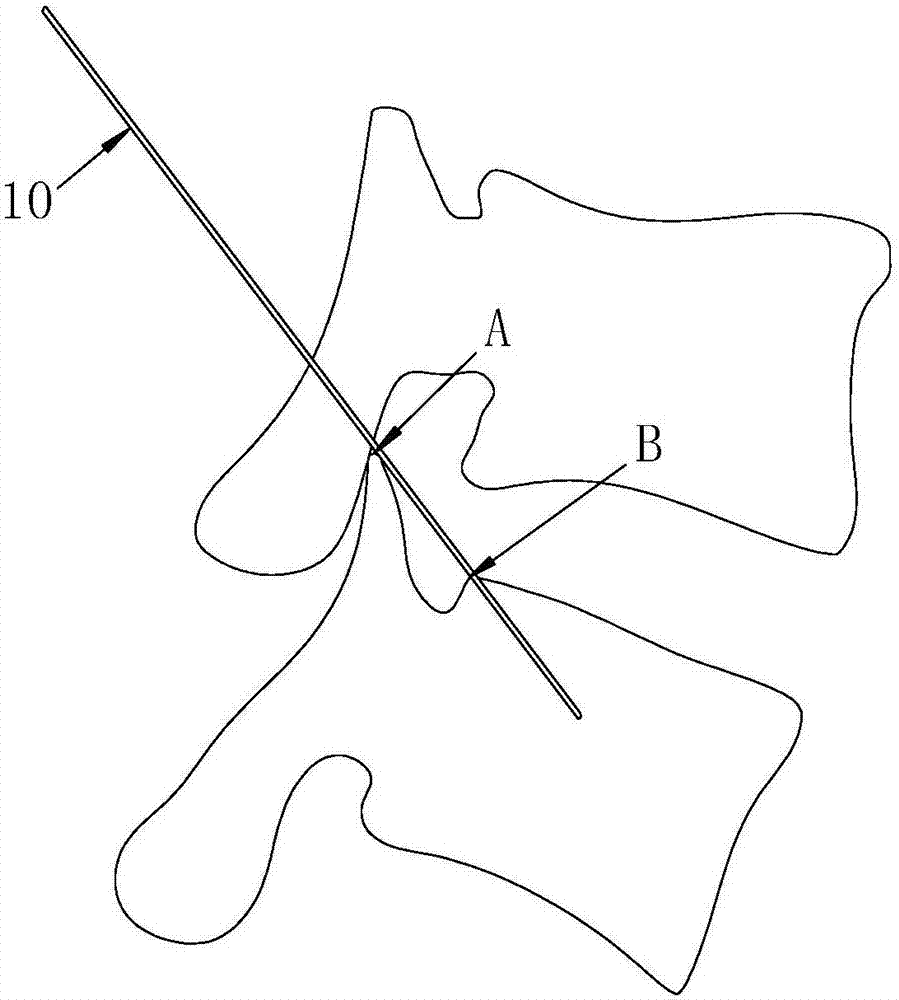Transforaminal endoscope operation positioning method based on X-ray machine