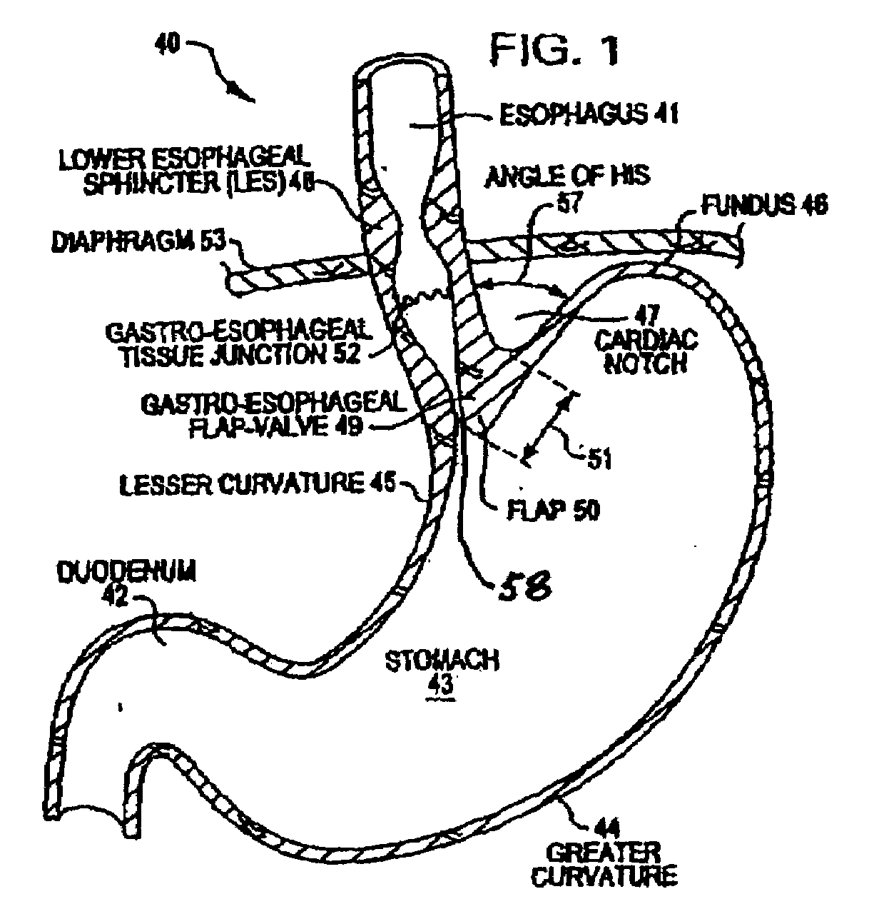 Transesophageal gastric reduction method and device for reducing the size of a previously formed gastric reduction pouch