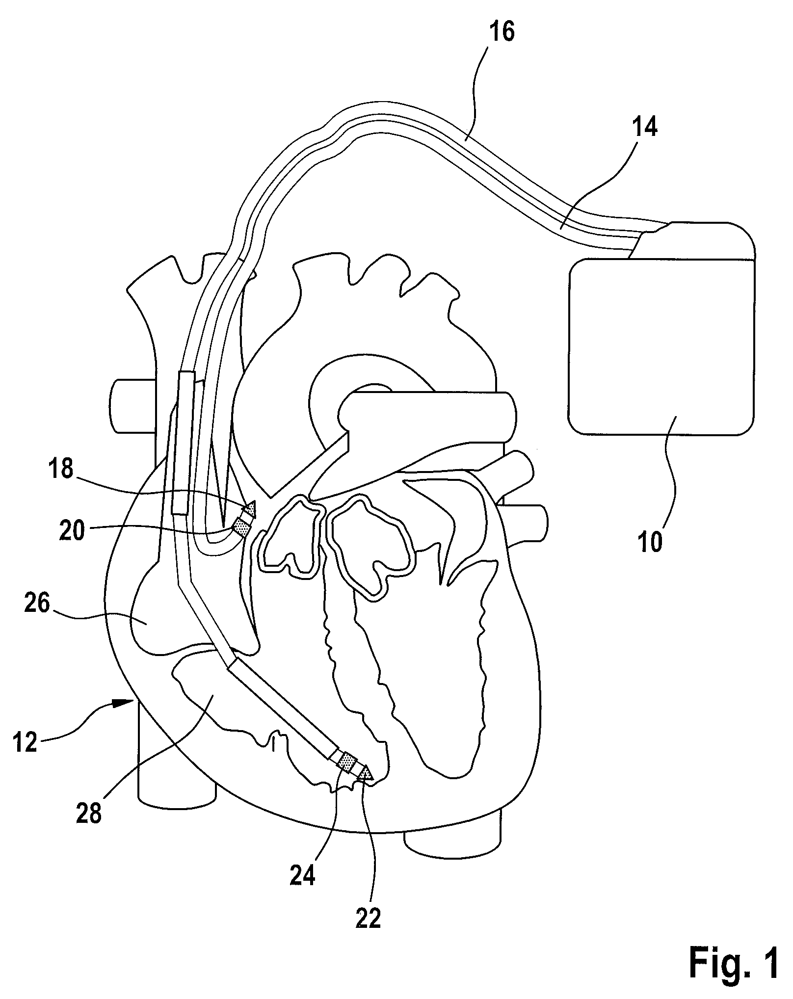 Heart stimulator