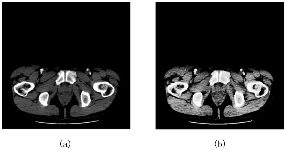 Automatic segmentation method for rectal cancer CT image based on U-Transformer