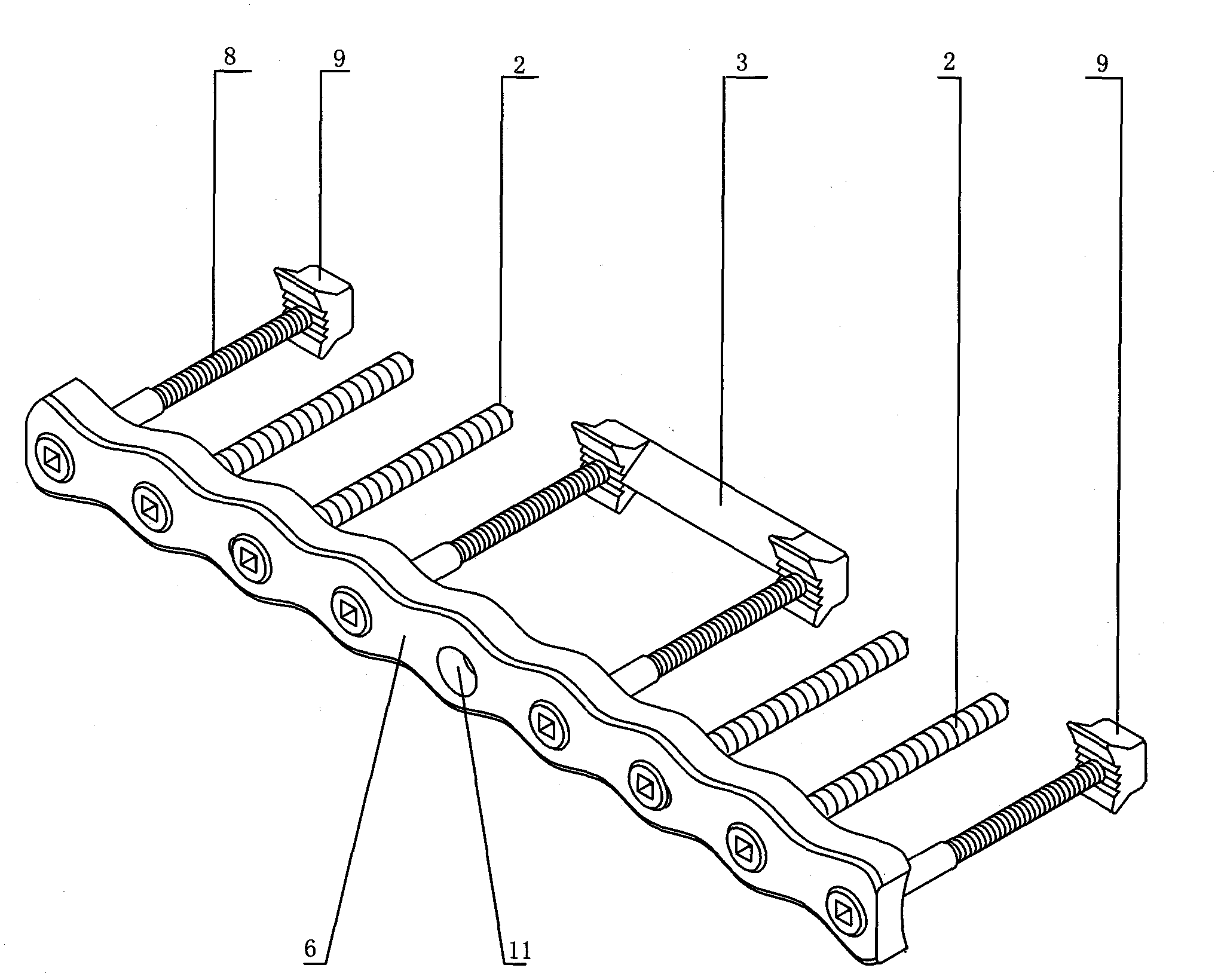 Femoral shaft fracture internally fixing instrument