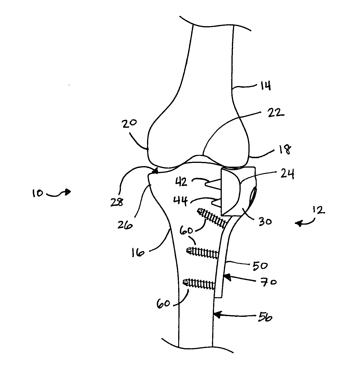 System and Method for Hemi Knee Replacement for Tibial Plateau Fracture