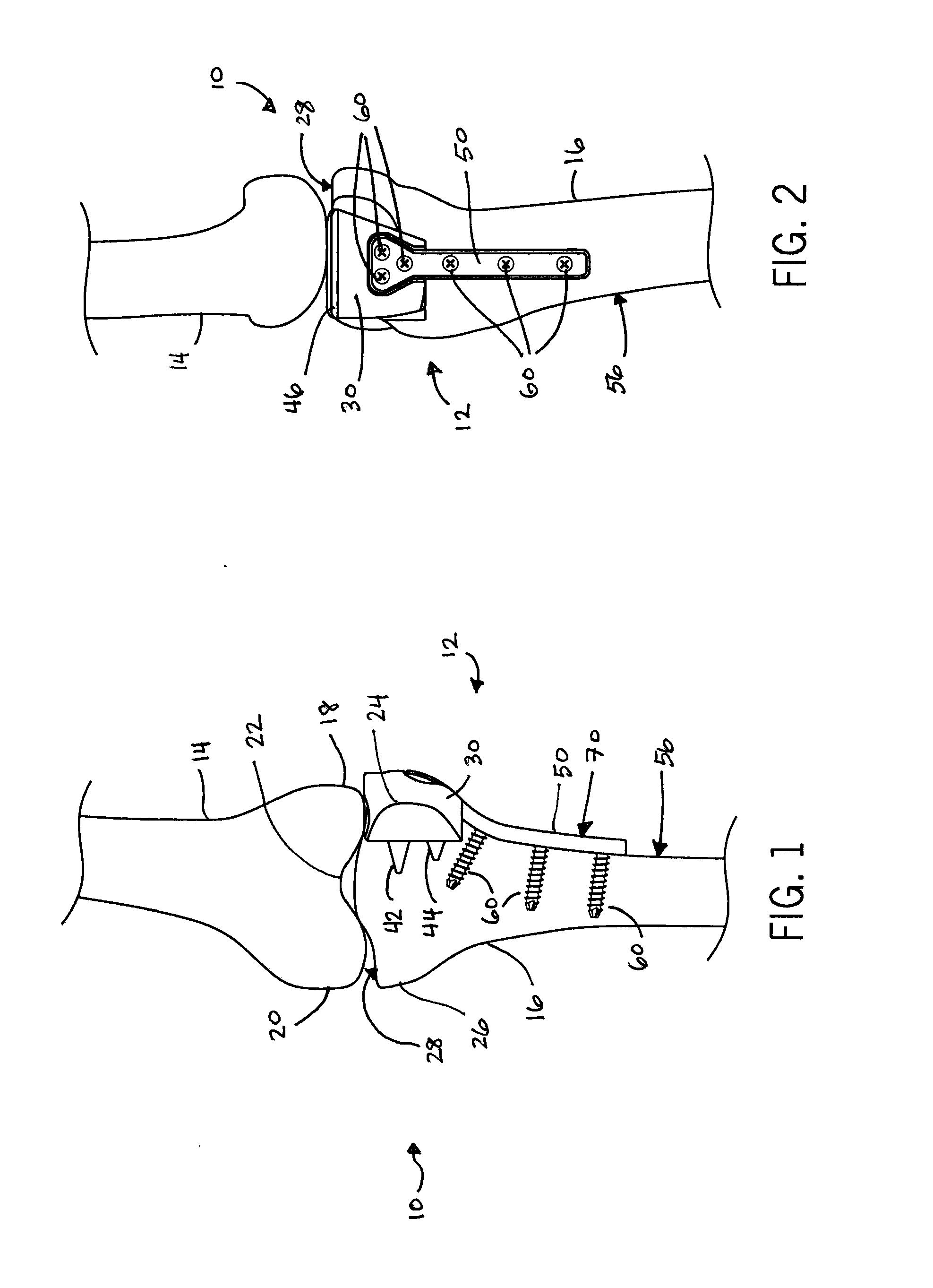 System and Method for Hemi Knee Replacement for Tibial Plateau Fracture