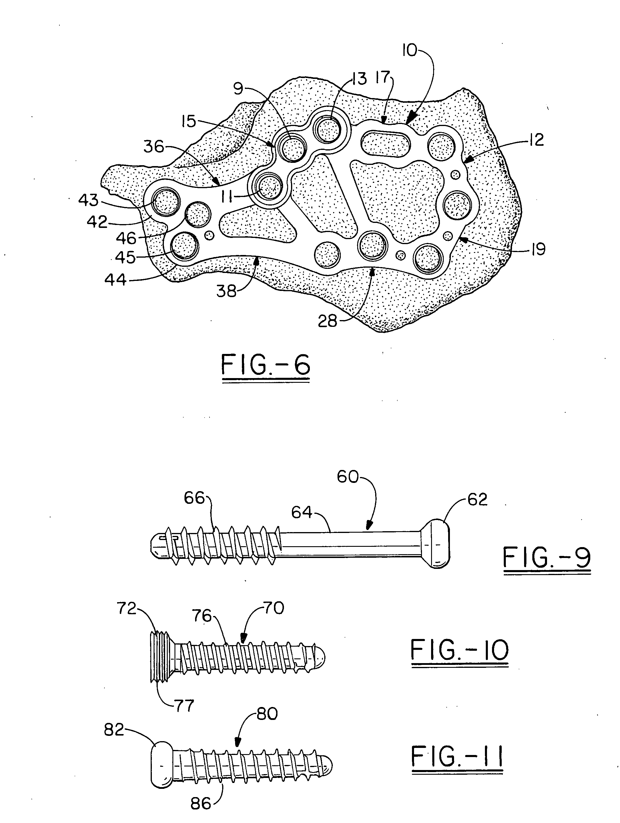 Calcaneal plate