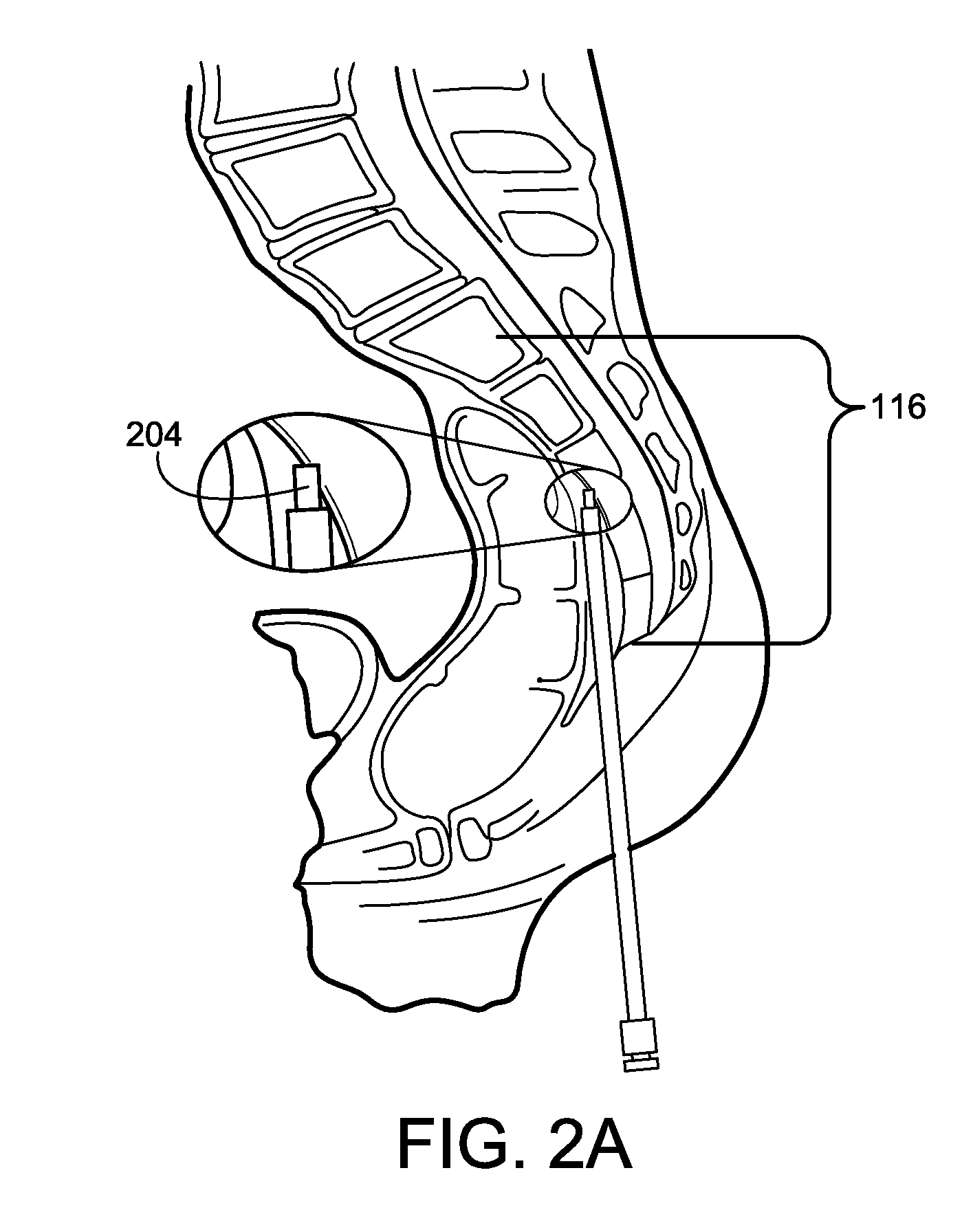 Methods for Deploying Spinal Motion Preservation Assemblies