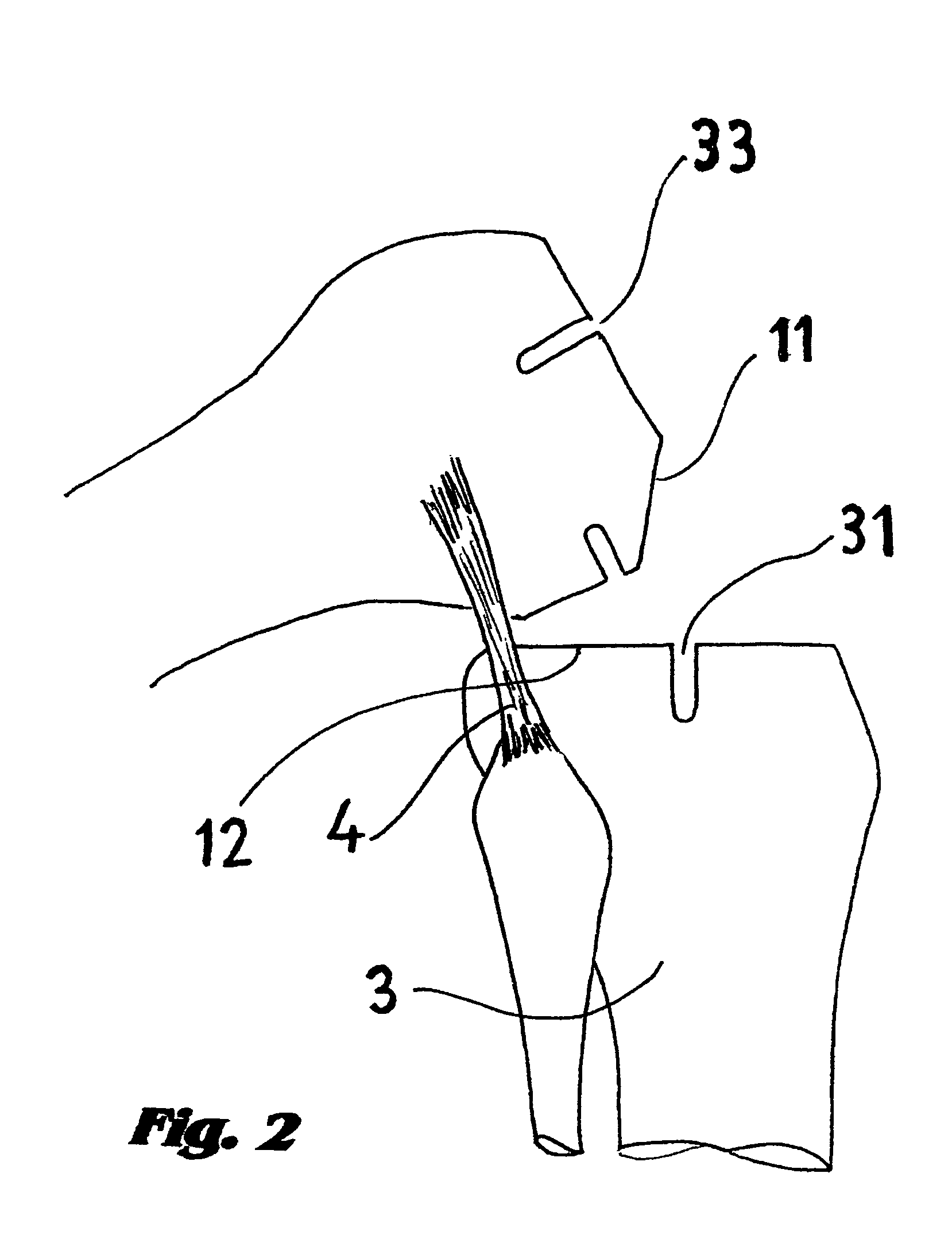 Bicondylar resurfacing prosthesis and method for insertion through direct lateral approach