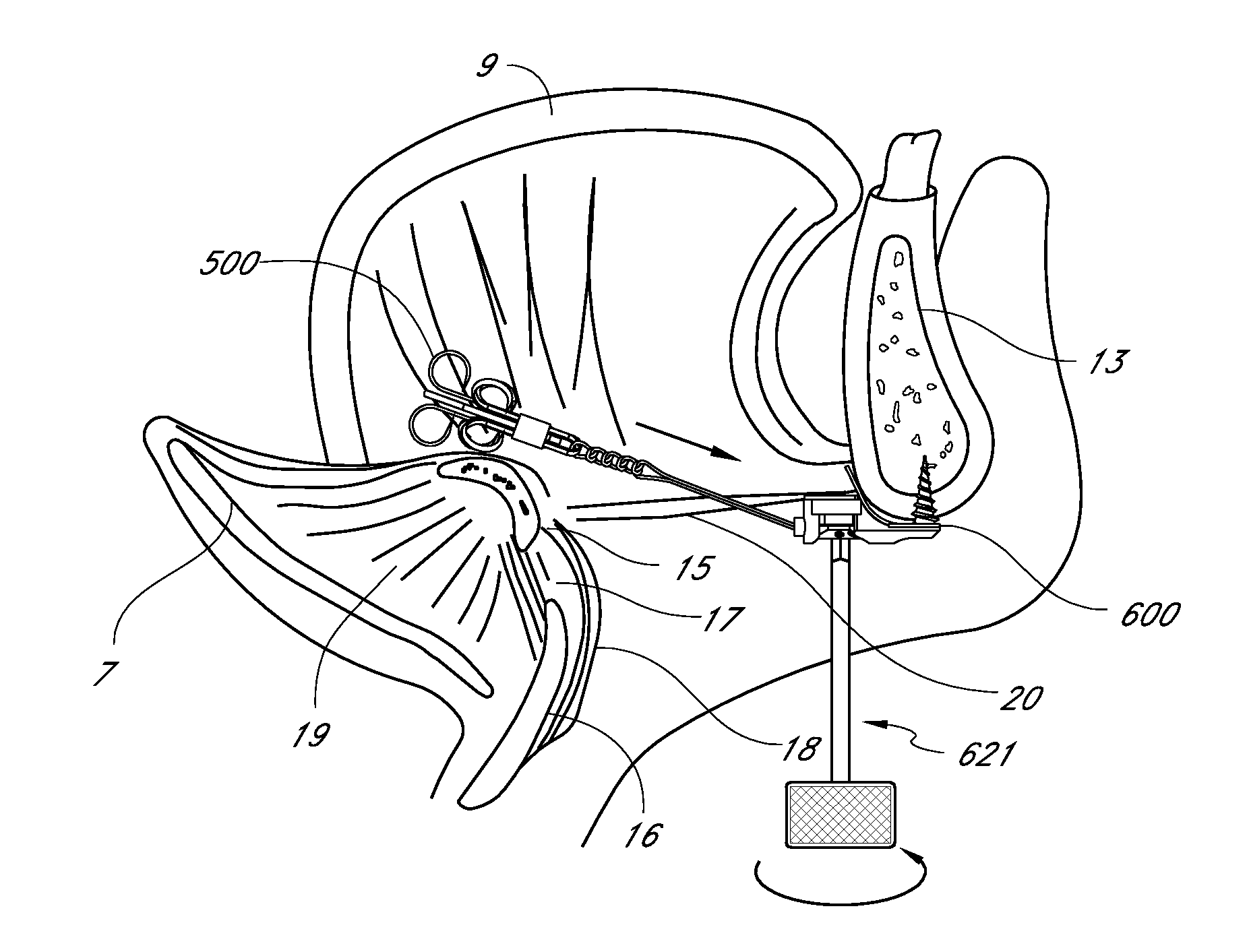 Glossopexy adjustment system and method