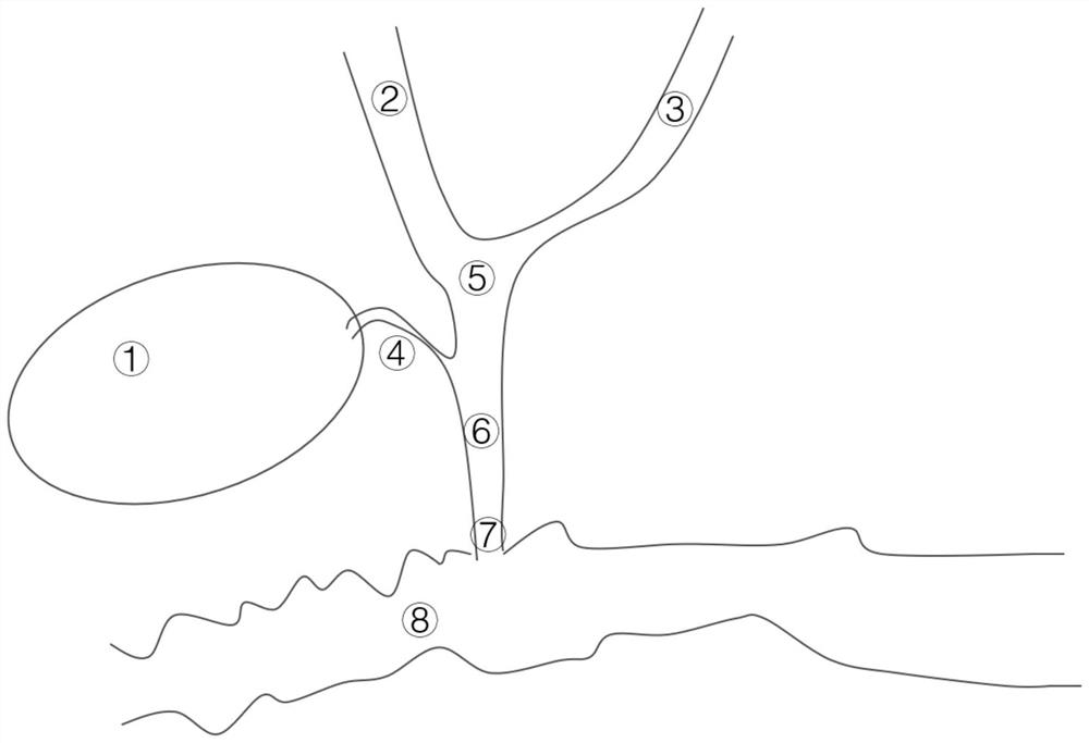 Method for establishing animal extrahepatic biliary tract malignant stenosis model