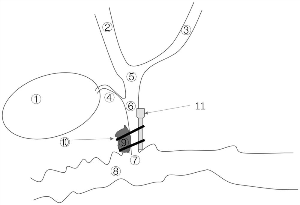 Method for establishing animal extrahepatic biliary tract malignant stenosis model