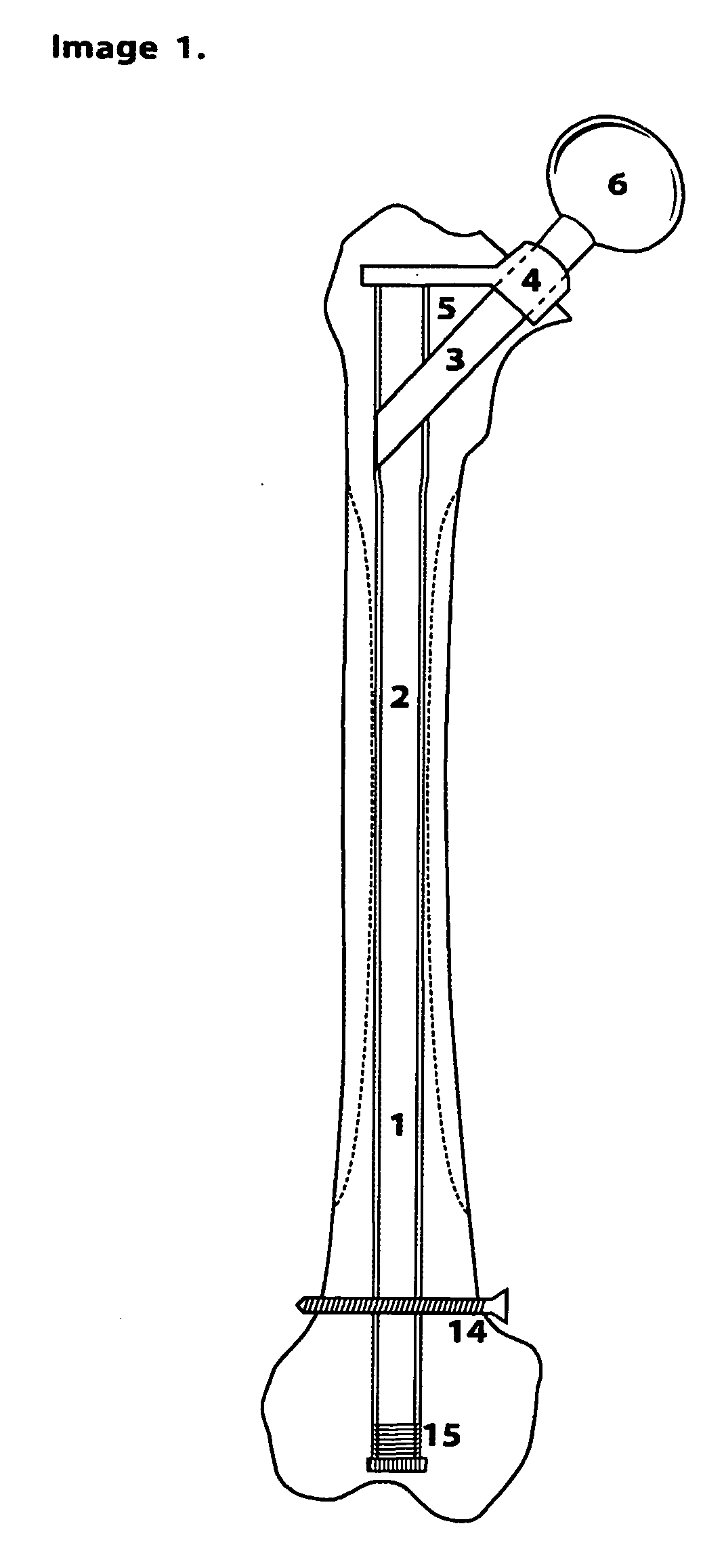O'Gara femur prosthesis