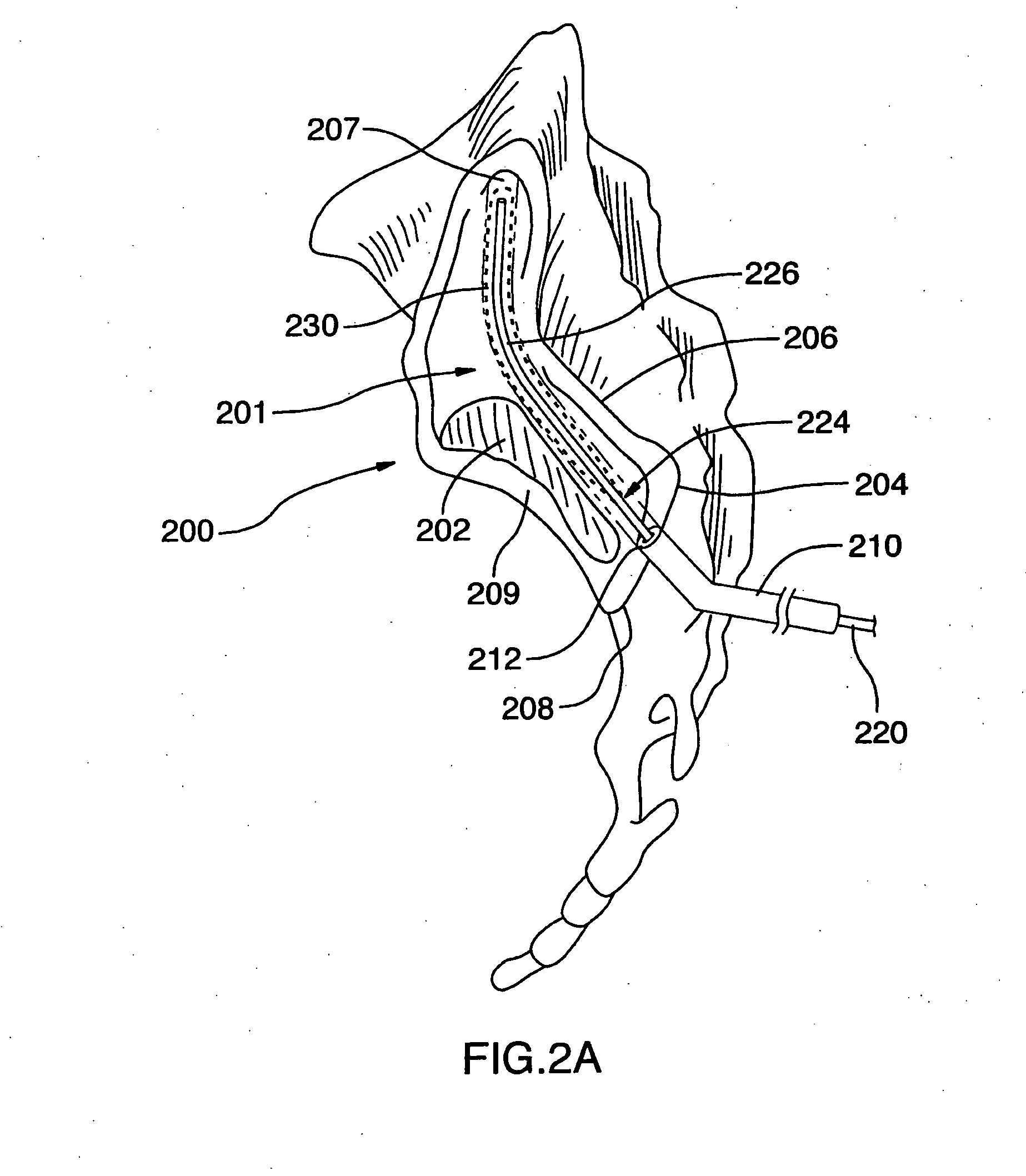 Methods of treating the sacroilac region of a patient's body