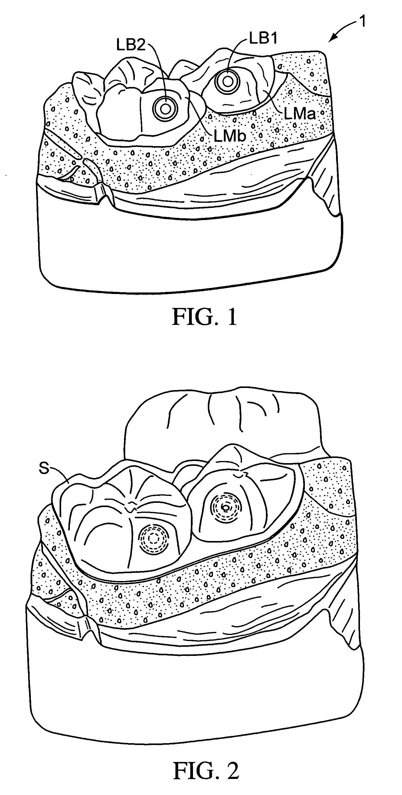 System and method for palatal expansion