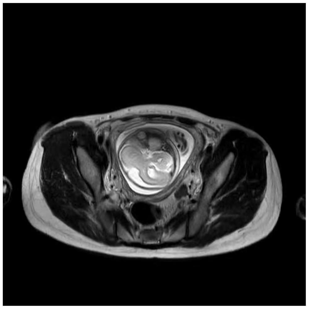 Fetal craniocerebral scanning three-point plane positioning method