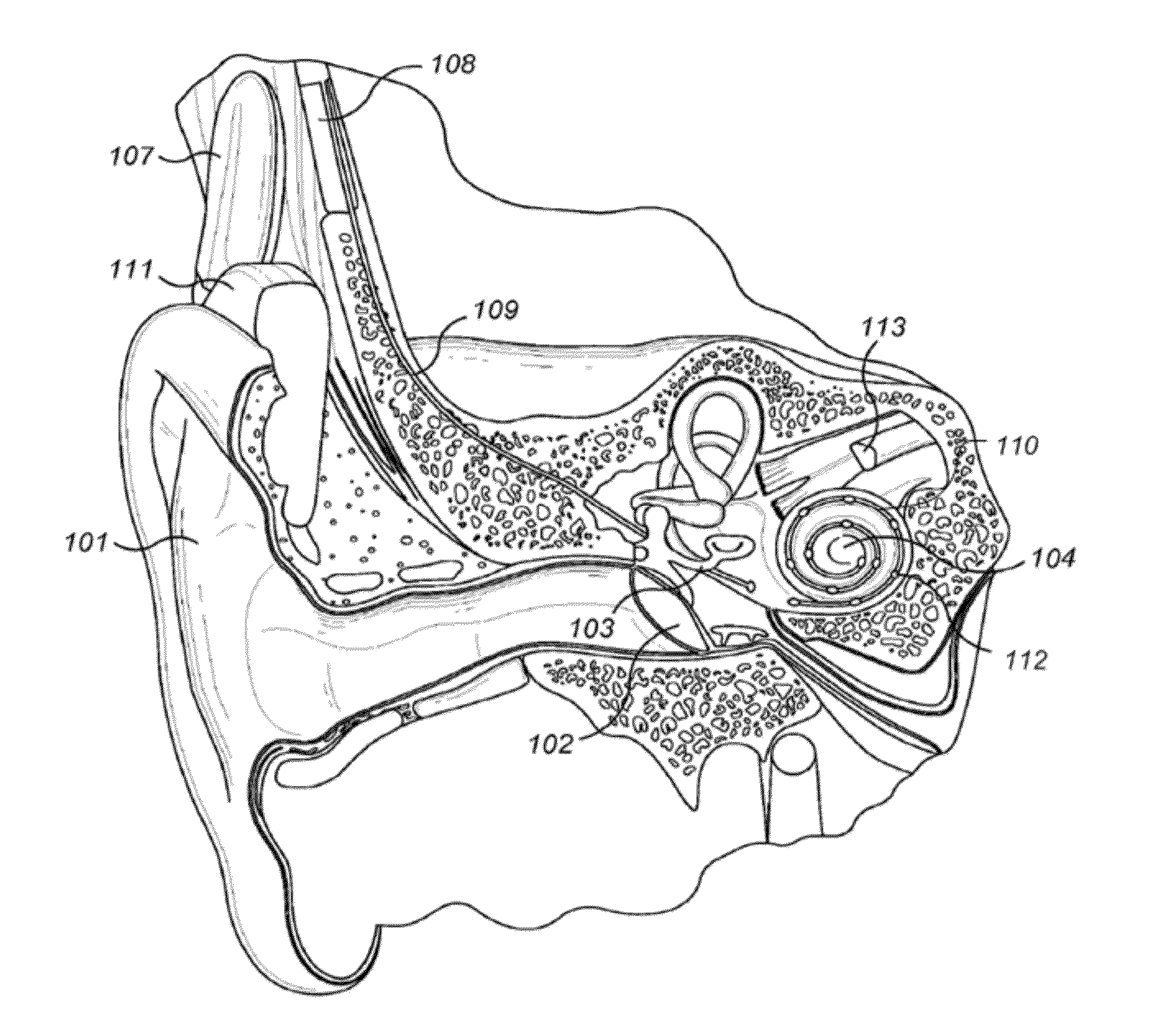 Reduction of Transient Sounds in Hearing Implants