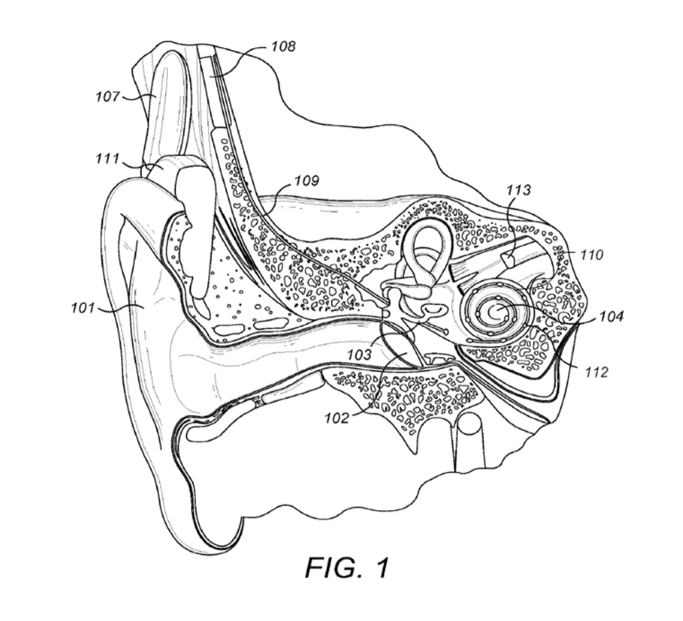 Reduction of Transient Sounds in Hearing Implants