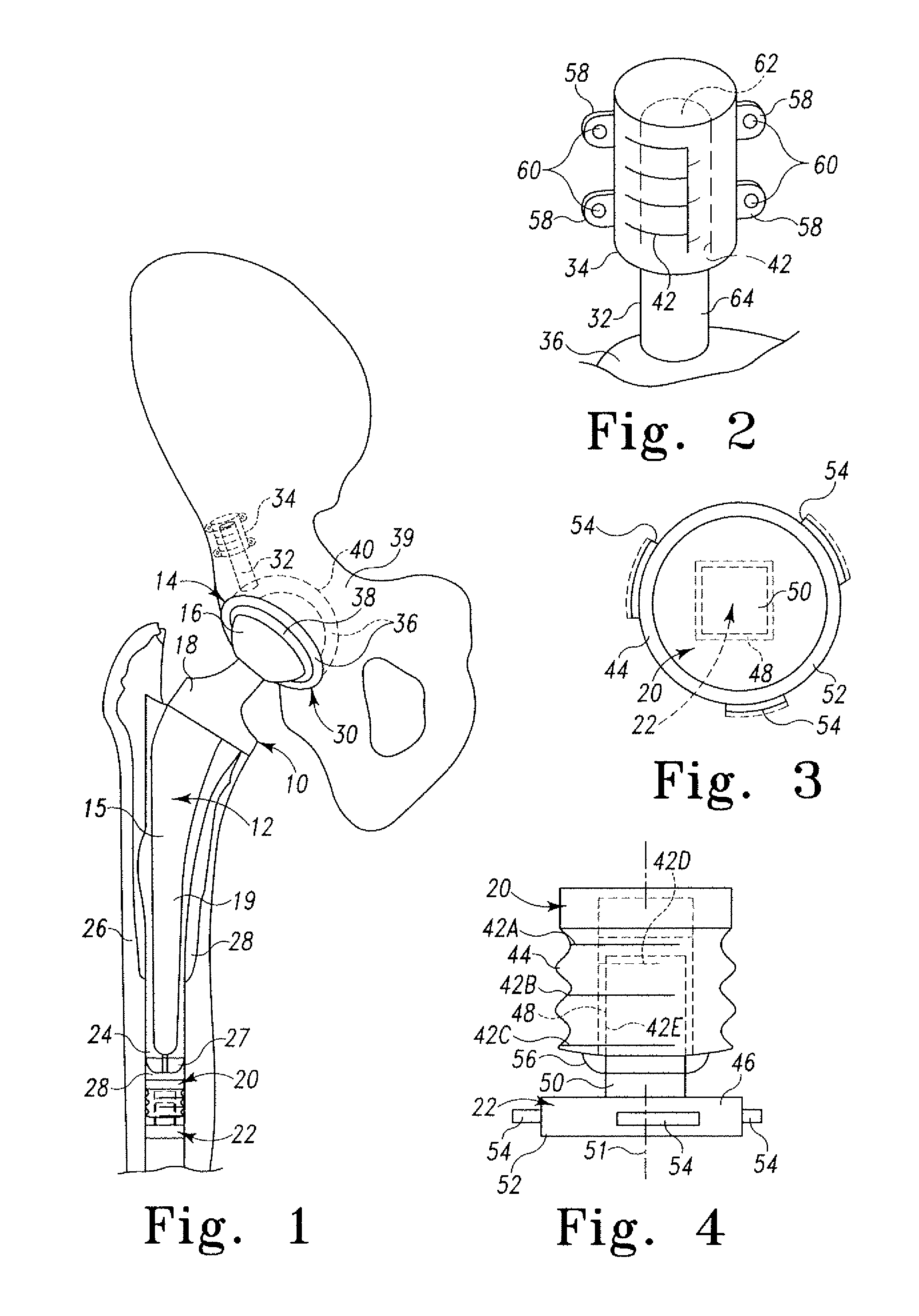 Implant system with migration measurement capacity