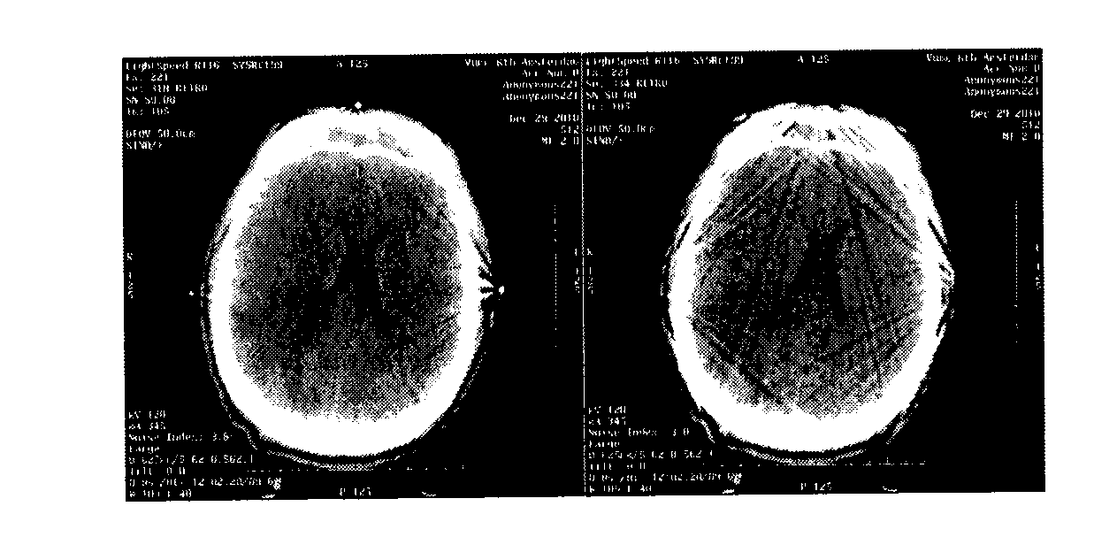 Method and device for reducing metal artifacts in medical images