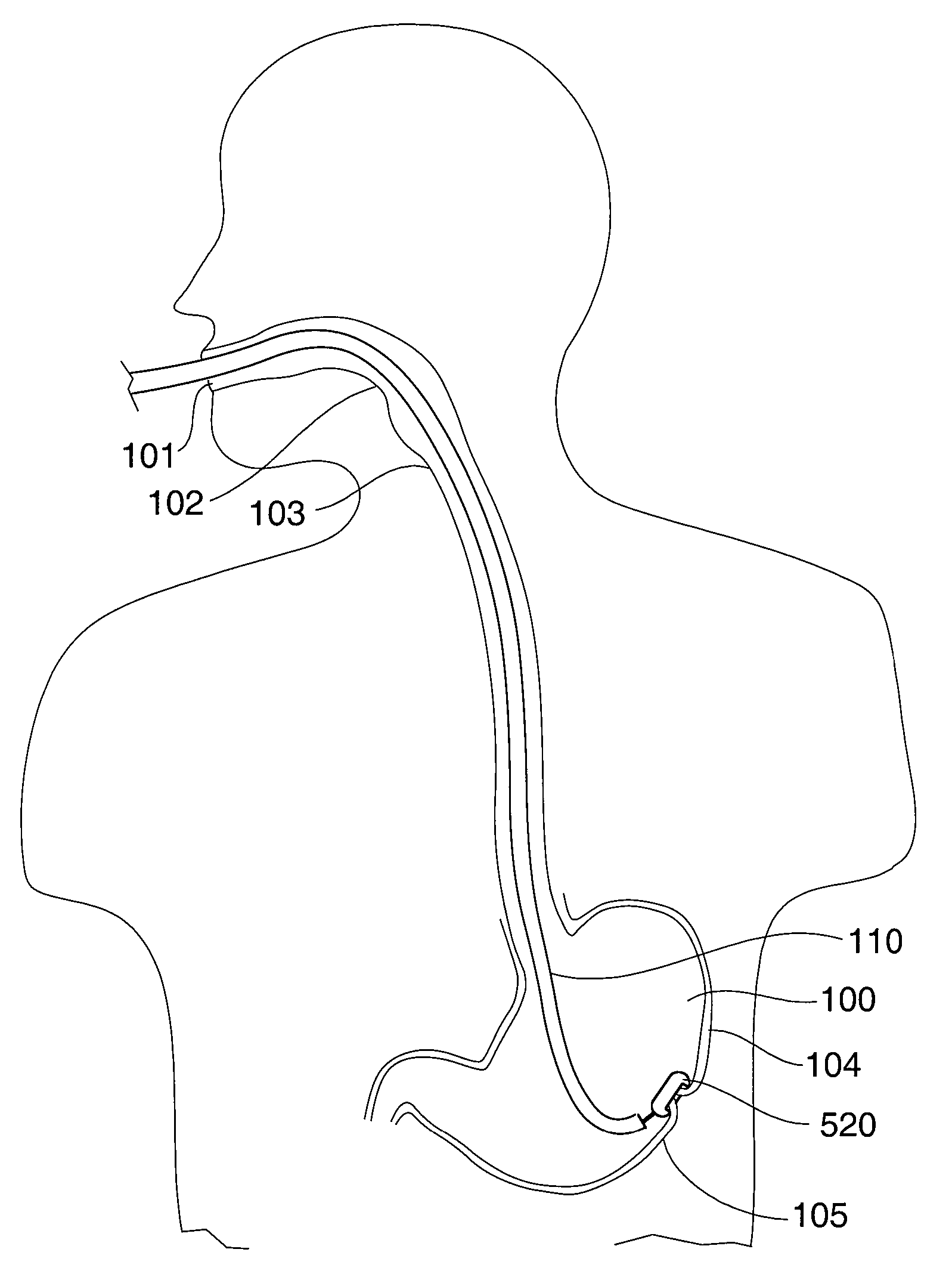 Endoscopic Instrument for Engaging a Device